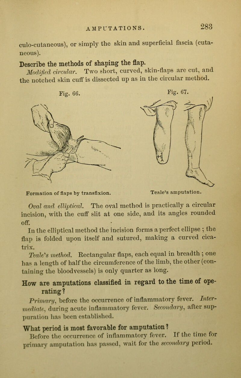 culo-cutaneous), or simply the sMn and superficial fascia (cuta- neous). Describe the methods of shaping the flap. Modified drmlar. Two short, curved, skin-flaps are cut, and the notched skin cuff is dissected up as in the circular method. Fig. Fig. 67. Formation of flaps by transfixion. Teale's amputation. Oval and elliptical The oval method is practically a circular incision, with the cuff sUt at one side, and its angles rounded off In the elliptical method the incision forms a perfect ellipse ; the flap is folded upon itself and sutured, making a curved cica- trix. Teale's method. Kectangular flaps, each equal in breadth ; one has a length of half the circumference of the Hmb, the other (con- taining the bloodvessels) is only quarter as long. How are amputations classified in regard to the time of ope- rating ? Primary, before the occurrence of inflammatory fever. Inter- mediate, during acute inflammatory fever. Secondary, after sup- puration has been established. What period is most favorable for amputation 1 Ikifore the occurrence of inflammatory fever. If the time for primary amputation has passed, wait for the secondary period.