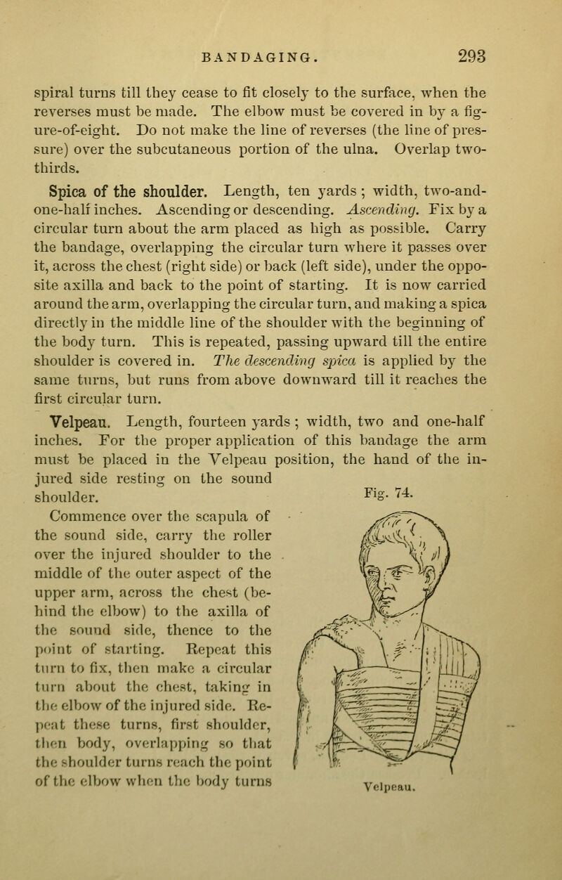spiral turns till they cease to fit closely to the surface, when the reverses must be made. The elbow must be covered in by a fig- ure-of-eight. Do not make the line of reverses (the line of pres- sure) over the subcutaneous portion of the ulna. Overlap two- thirds. Spica of the shoulder. Length, ten yards ; width, two-and- one-hali inches. Ascending or descending. Ascending. Fix by a circular turn about the arm placed as high as possible. Carry the bandage, overlapping the circular turn where it passes over it, across the chest (right side) or back (left side), under the oppo- site axilla and back to the point of starting. It is now carried around the arm, overlapping the circular turn, and making a spica directly in the middle line of the shoulder with the beginning of the body turn. This is repeated, passing upward till the entire shoulder is covered in. The descending spica is applied by the same turns, but runs from above downward till it reaches the first circular turn. Velpeau. Length, fourteen yards ; width, two and one-half inches. For the proper application of this bandage the arm must be placed in the Yelpeau position, the hand of the in- jured side resting on the sound shoulder. Commence over the scapula of the sound side, carry the roller over the injured shoulder to the middle of the outer aspect of the upper arm, across the chest (be- hind the elbow) to the axilla of the sound side, thence to the point of starting. Repeat this turn to fix, then make a circular turn about the chest, taking in the elbow of the injured side. Re- peat these turns, first shoulder, then body, overlapping so that the shoulder turns reach the point of the elbow when the body turns Velpeau. Fiff. 74.