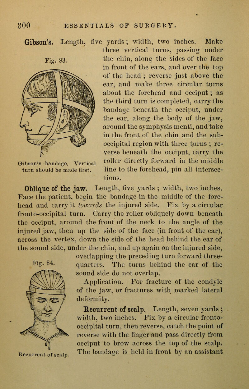 Gibson's. Length, five yards; width, two three vertical turns. inches. Make passing under G-ibson's bandage. Vertical turn should be made tirst. the chin, along the sides of the face in front of the ears, and over the top of the head ; reverse just above the ear, and make three circular turns about the forehead and occiput; as the third turn is completed, carry the bandage beneath the occiput, under the ear, along the body of the jaw, around the symphysis menti, andtake in the front of the chin and the sub- occipital region with three turns ; re- verse beneath the occiput, carry the roller directly forward in the middle line to the forehead, pin all intersec- tions. Oblique of the jaw. Length, five yards ; width, two inches. Face the patient, begin the bandage in the middle of the fore- head and carry it tmmrds the injured side. Fix by a circular fronto-occipital turn. Carry the roller obliquely down beneath the occiput, around the front of the neck to the angle of the injured jaw, then up the side of the face (in front of the ear), across the vertex, down the side of the head behind the ear of the sound side, under the chin, and up again on the injured side, overlapping the preceding turn forward three- quarters. The turns behind the ear of the sound side do not overlap. Application. For fracture of the condyle of the jaw, or fractures with marked lateral deformity. Recurrent of scalp. Length, seven yards ; width, two inches. Fix by a circular fronto- occipital turn, then reverse, catch the point of reverse with the finger and pass directly from occiput to brow across the top of the scalp. Recurrent of scalp. The bandage is held in front by an assistant Fig. 84.