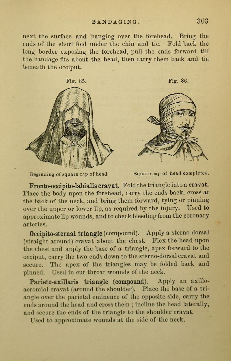 next the surface and hanging over the forehead. Bring the ends of the short fold under the chin and tie. Fold back the long border exposing the forehead, pull the ends forward till the bandage fits about the head, then carry them back and tie beneath the occiput. Fig. Beginning of square cap of head. Square cap of head completeu. Fronto-occipito-labialis cravat. Fold the triangle into a cravat. Place the body upon the forehead, carry the ends back, cross at the back of the neck, and bring them forward, tying or pinning over the upper or lower hp, as required by the injury. Used to approximate lip wounds, and to check bleeding from the coronary arteries. Occipito-sternal triangle (compound). Apply a sterno-dorsal (straight around) cravat about the chest. Flex the head upon the chest and apply the base of a triangle, apex forward to the occiput, carry the two ends down to the sterno-dorsal cravat and secure. The apex of the triangles may be folded back and pinned. Used in cut throat wounds of the neck. Parieto-axillaris triangle (compound). Apply an axillo- acromial cravat (around the shoulder). Place the base of a tri- angle over the parietal eminence of the opposite side, carry the ends around the head and cross them ; incline the head laterally, and secure tlie ends of the triangle to the shoulder cravat. Used to approximate wounds at the .side of the neck.