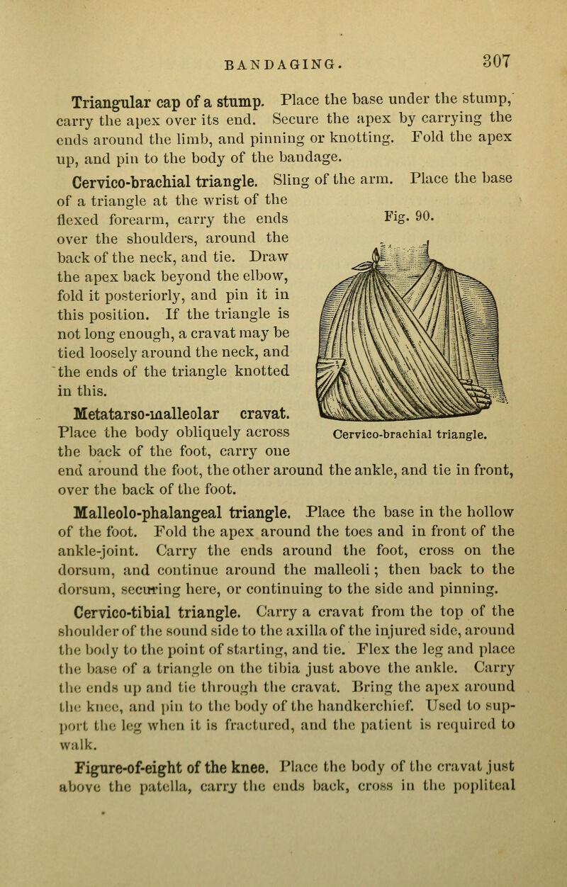 Triangular cap of a stump. Place the base under the stump, carry the apex over its end. Secure the apex by carrying the ends around the hmb, and pinning or knotting. Fold the apex up, and pin to the body of the bandage. Cervico-brachial triangle. SUng of the arm. Place the base of a triangle at the wrist of the flexed forearm, carry the ends over the shoulders, around the back of the neck, and tie. Draw the apex back beyond the elbow, fold it posteriorly, and pin it in this position. If the triangle is not long enough, a cravat may be tied loosely around the neck, and ' the ends of the triangle knotted in this. Metatarso-inalleolar cravat. Place the body obliquely across the back of the foot, carry one end around the foot, the other around the ankle, and tie in front, over the back of the foot. Malleolo-phalangeal triangle. Place the base in the hollow of the foot. Fold the apex around the toes and in front of the ankle-joint. Carry the ends around the foot, cross on the dorsum, and continue around the malleoli; then back to the dorsum, securing here, or continuing to the side and pinning. Cervico-tibial triangle. Carry a cravat from the top of the shoulder of the sound side to the axilla of the injured side, around the body to the point of starting, and tie. Flex the leg and place the base of a triangle on the tibia just above the ankle. Carry the ends up and tie through the cravat. Bring the apex around the knee, and pin to the body of the handkerchief. Used to sup- port the leg when it is fractured, and the patient is reciuired to walk. Figure-of-eight of the knee. Place the body of the cravat just above the patella, carry the ends back, cross in the popliteal Oervico-brachial triangle.
