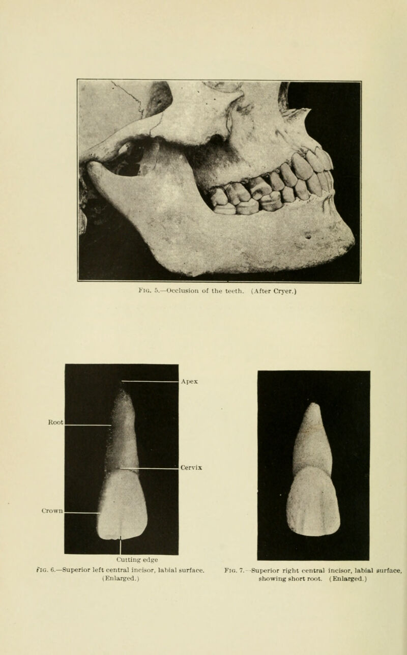 Vm. 5.—Ucclusiou of the let-tli. vAfter Cryer.) Root Apex Cutting edge fiG. 6.—Superior left central incisor, labial surface. (Enlarged.) Fig. 7.- -Superior right central incisor, labial gurface, showing short root. (Elnlarged.)