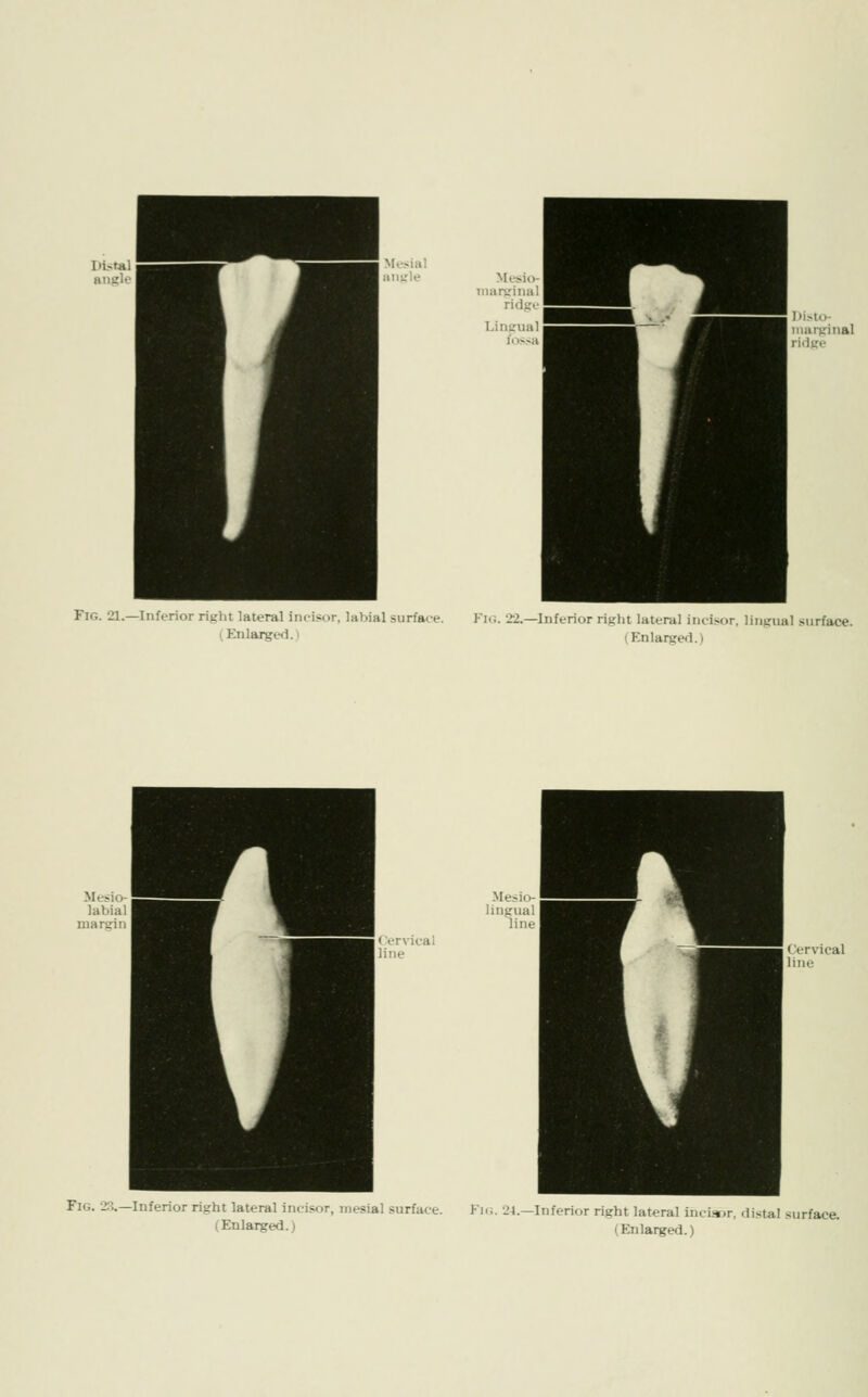 Fig. 21.—InftTior right lateral incisor, labial surface. Fl«. 22.—Inferior right lateral iiKi.M)r, liiijiual surface. lEnlargi-d.i (Enlarged.) Fig. 23.—Inferior right lateral incisor, mesial surface. Ki<;. 24.—Inferior right lateral incLt.r, distal surface.