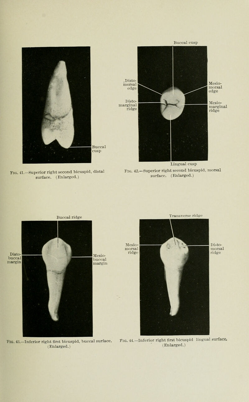 Fig. 41.—Superior right second bicuspid, distal surface. (Enlarged.) Lingual cusp Fig. 42.—Superior right second bicuspid, morsal surface. (Enlarged.) Buccal ridge Transverse ridge Fig. 43. -Inferior right first bicuspid, buccal surface. (Enlarged.) Fig. 44.—Inferior right first bicuspid lingual surface.