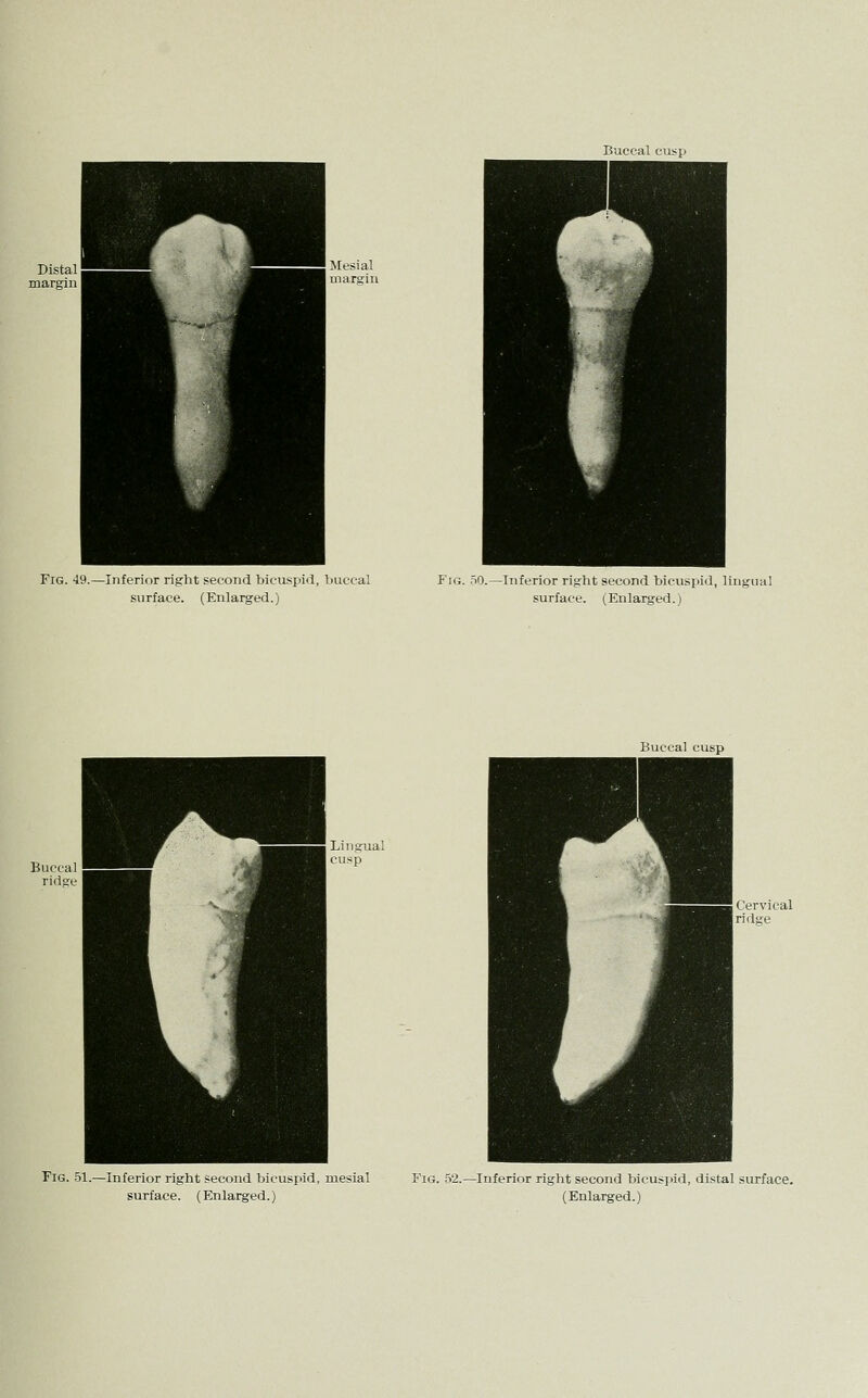 Fig. 49.- Inferior right second bicuspirl, buccal surface. (Enlarged.) -Inferior right second bicuspid, lingual surface. (Enlarged.) Buccal cusp Fig. .51.—Inferior right second bicuspid, mesial Fig. 52.—Inferior right second bicusjiid, distal surface.