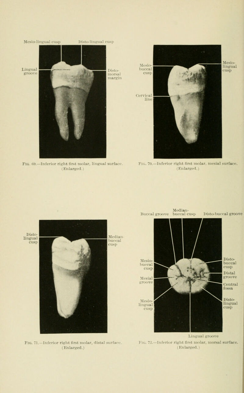 Mcsio-liMLTiiiiI cusii Disto-titiiriinl cu^ii Misii.- l>isto- l.ufoal iiiui-sal ^^^I' niarsiii Cervica liiK Fig. i'>9.—Inferior ri^flit tirst uKilar, liiiKiial siirfan (Enlarged. I lii;. 70.—Inferior rixlit lirst molar, mesial surface. (Knlariieil.; Median- huccal groove luieeal cus)i l»isto-tiiic<-al groove Disto- buccal ' '■  ^^^ Distal groove (,'entral fossa Disto- lingual cusp Fig. 71.—Inferior riglit first molar, distal siirlac Lingual groove I-'ii;. 7-'.—Inferior right first molar, morsal surface.