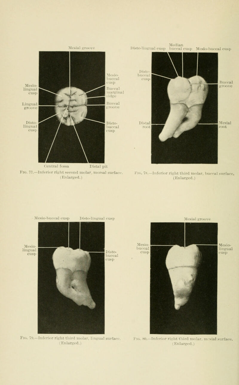 Central fossa I'istal i)it Kk;. 77.—Inferior rifrlit seron<l mohir, niorsal surface, (H^iilarged.) M.'.liaii Kisto-liuuMial fu>\> l.iiceal lU-p Mi siol.u,-, al ensp Dist hlieejil 1-Ki. 7s. —Inferior riirlit third molar, liueeal surfai (Knlarged.) Mesio-l.iieeal cusp ])i>tn-lin^'ual eusp Mesial irroove Fig. 79.—Inferior rit,'lit third molar, lininial siirfaee. Fif;. Ml.—Inferior ri;,'ht third molar, m -sial snrfaee.