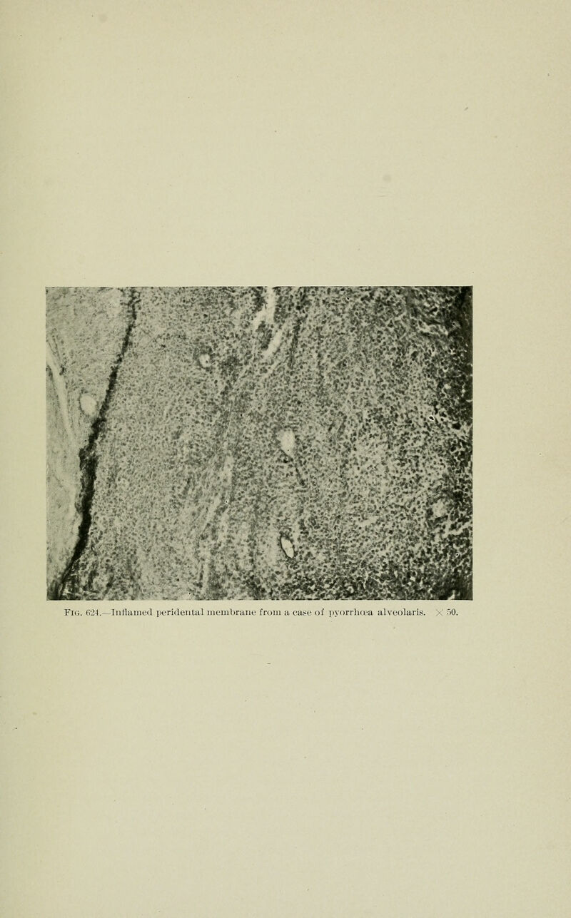 / Fig. 624.—Iiitiaineil iii-'ri<leutal membrane from a case of pyorrhcea alveolaris. X '^0.