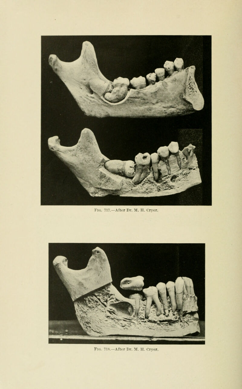 Fic. 717—After Dr. M. H. tTver. Fic. 71 s.—After Dr. M. H. Orver.