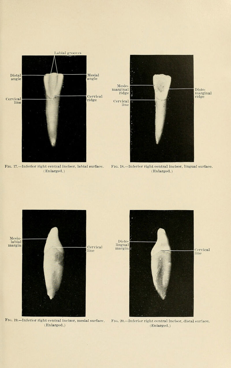 Mesial angle Mesio- marginal ridge Cervical ridge Cervical line Fig. 17.—Inferior right central incisor, labial surface. Fig. 18.—Inferior right central incisor, lingual surface. (En larged.) (Enlarged.) Fig. 19.—Inferior right central incisor, mesial surface. Fig. 20.—Inferior right central incisor, distal surface.