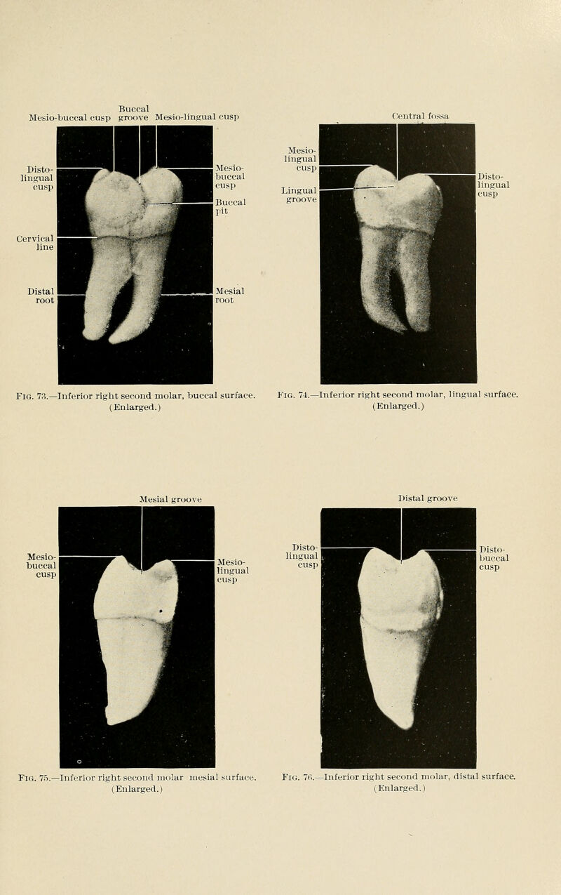 Buccal Mesio-buccal cusp groove Mesio-lingual cusp Central fossa Mesio- l)uccal Mesio- lingual cusp cusp Lingual Buccal pit; groove Mesial root Fig. 73.—Inferior right second molar, buccal surface. Fig. 7i.—Inferior right second molar, lingual surface. (Enlarged.) (Enlarged.) Mesial groove Distal groove Disto- lingual cusp < Disto- huccal cusp Fig. 75.—Inferior right second molar mesial surface. Fig. 76.—Inferior right second molar, distal surface.