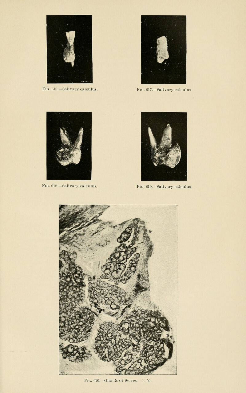 Fig. 616.—Salivary calculus. Fig. 617.—Salivary calculus. Fig. 61«.—Salivarv calculus. Fig. 619.—Salivarv calculus. Fig. C20.—Glands of Serres. X 50.