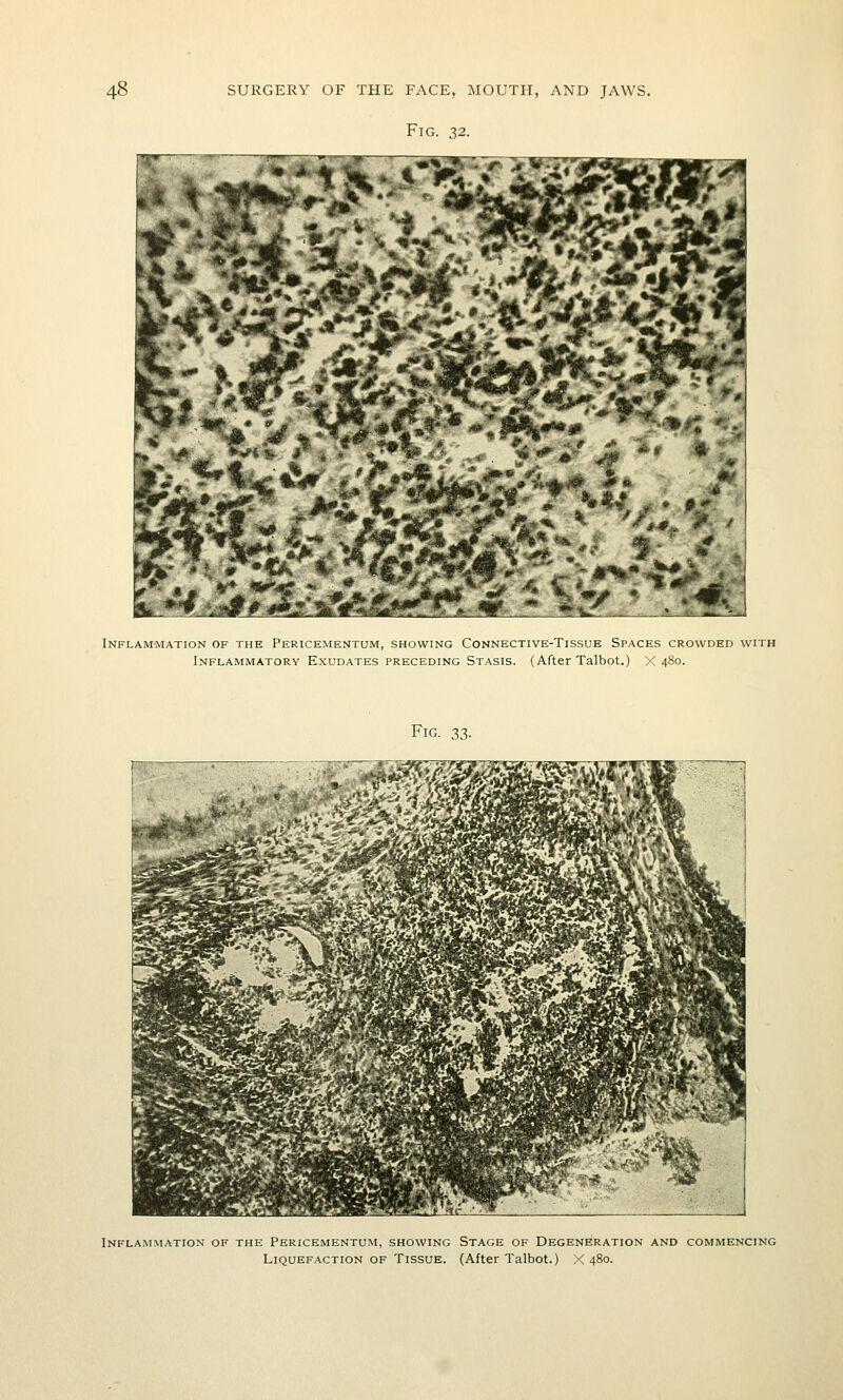 Fig. 32. .^^.v^€A^% ji?. Jtnij: Inflammation of the Pericementum, showing Connective-Tissue Spaces crowded with Inflammatory Exudates preceding Stasis. (After Talbot.) X 480. Fig. 33. Inflammation of the Pericementum, showing Stage of Degeneration and commencing Liquefaction of Tissue. (After Talbot.) X 480.