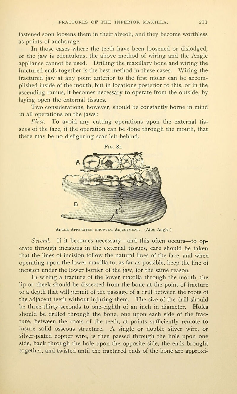 fastened soon loosens them in their alveoli, and they become worthless as points of anchorage. In those cases where the teeth have been loosened or dislodged, or the jaw is edentulous, the above method of wiring and the Angle appliance cannot be used. Drilling the maxillary bone and wiring the fractured ends together is the best method in these cases. Wiring the fractured jaw at any point anterior to the first molar can be accom- plished inside of the mouth, but in locations posterior to this, or in the ascending ramus, it becomes necessary to operate from the outside, by laying open the external tissues. Two considerations, however, should be constantly borne in mind in all operations on the jaws: First. To avoid any cutting operations upon the external tis- sues of the face, if the operation can be done through the mouth, that there may be no disfiguring scar left behind. Fig. 8i. SHSi^H^^^^^^^^,^ Angle Apparatus, showing Adjustment. (After Angle.) Second. If it becomes necessary—and this often occurs—to op- erate through incisions in the external tissues, care should be taken that the lines of incision follow the natural lines of the face, and when operating upon the lower maxilla to, as far as possible, keep the line of incision under the lower border of the jaw, for the same reason. In wiring a fracture of the lower maxilla through the mouth, the lip or cheek should be dissected from the bone at the point of fracture to a depth that will permit of the passage of a drill between the roots of the adjacent teeth without injuring them. The size of the drill should be three-thirty-seconds to one-eighth of an inch in diameter. Holes should be drilled through the bone, one upon each side of the frac- ture, between the roots of the teeth, at points sufficiently remote to insure solid osseous structure. A single or double silver wire, or silver-plated copper wire, is then passed through the hole upon one side, back through the hole upon the opposite side, the ends brought together, and twisted until the fractured ends of the bone are approxi-