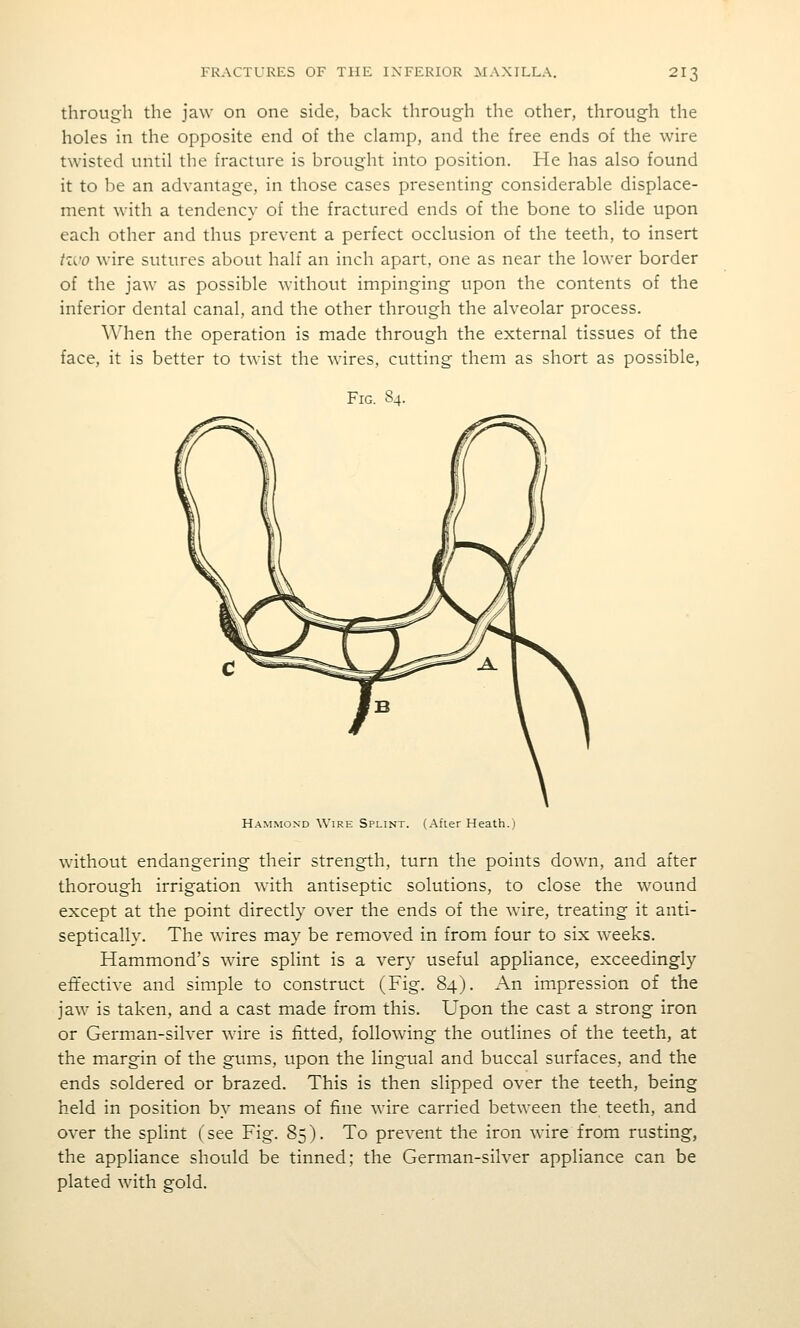 through the jaw on one side, back through the other, through the holes in the opposite end of the clamp, and the free ends of the wire twisted until the fracture is brought into position. He has also found it to be an advantage, in those cases presenting considerable displace- ment with a tendency of the fractured ends of the bone to slide upon each other and thus prevent a perfect occlusion of the teeth, to insert izi'o wire sutures about half an inch apart, one as near the lower border of the jaw as possible without impinging upon the contents of the inferior dental canal, and the other through the alveolar process. When the operation is made through the external tissues of the face, it is better to twist the wires, cutting them as short as possible. Fig. 84. Hammond Wire Splint. (After Heath.) without endangering their strength, turn the points down, and after thorough irrigation with antiseptic solutions, to close the wound except at the point directly over the ends of the wire, treating it anti- septically. The wires may be removed in from four to six weeks. Hammond's wire splint is a very useful appliance, exceedingly effective and simple to construct (Fig. 84). An impression of the jaw is taken, and a cast made from this. Upon the cast a strong iron or German-silver wire is fitted, following the outlines of the teeth, at the margin of the gums, upon the lingual and buccal surfaces, and the ends soldered or brazed. This is then slipped over the teeth, being held in position by means of fine wire carried between the teeth, and over the splint (see Fig. 85). To prevent the iron wire from rusting, the appliance should be tinned; the German-silver appliance can be plated with gold.