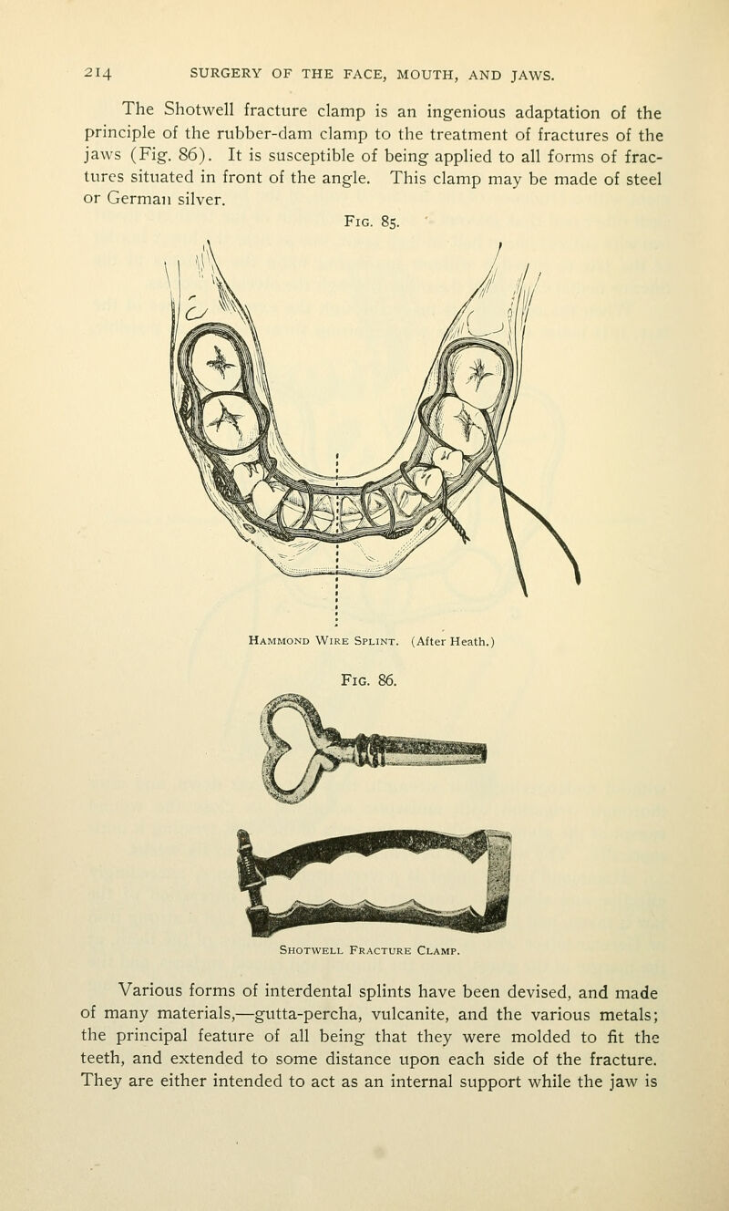 The Shotwell fracture clamp is an ingenious adaptation of the principle of the rubber-dam clamp to the treatment of fractures of the jaws (Fig. 86). It is susceptible of being applied to all forms of frac- tures situated in front of the angle. This clamp may be made of steel or German silver. Fig. 8s. Hammond Wire Splint. (After Heath.) Fig. 86. Shotwell Fracture Clamp. Various forms of interdental splints have been devised, and made of many materials,—gutta-percha, vulcanite, and the various metals; the principal feature of all being that they were molded to fit the teeth, and extended to some distance upon each side of the fracture. They are either intended to act as an internal support while the jaw is