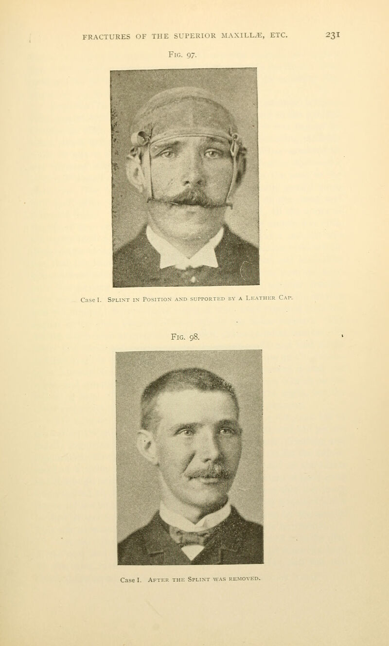 Fig. 97. Case I. Splint in Position and supported by a Leather Cap. Fig. 98.