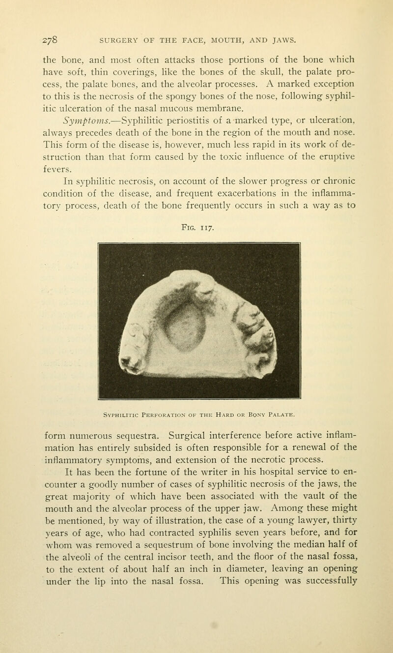 the bone, and most often attacks those portions of the bone which have soft, thin coverings, like the bones of the skull, the palate pro- cess, the palate bones, and the alveolar processes. A marked exception to this is the necrosis of the spongy bones of the nose, following syphil- itic ulceration of the nasal mucous membrane. Symptoms.-—Syphilitic periostitis of a marked type, or ulceration, always precedes death of the bone in the region of the mouth and nose. This form of the disease is, however, much less rapid in its work of de- struction than that form caused by the toxic influence of the eruptive fevers. In syphilitic necrosis, on account of the slower progress or chronic condition of the disease, and frequent exacerbations in the inflamma- tory process, death of the bone frequently occurs in such a way as to Fig. 117. Syphilitic Perforation of the Hard or Bony Palate. form numerous sequestra. Surgical interference before active inflam- mation has entirely subsided is often responsible for a renewal of the inflammatory symptoms, and extension of the necrotic process. It has been the fortune of the writer in his hospital service to en- counter a goodly number of cases of syphilitic necrosis of the jaws, the great majority of which have been associated with the vault of the mouth and the alveolar process of the upper jaw. Among these might be mentioned, by way of illustration, the case of a young lawyer, thirty years of age, who had contracted syphilis seven years before, and for whom was removed a sequestrum of bone involving the median half of the alveoli of the central incisor teeth, and the floor of the nasal fossa, to the extent of about half an inch in diameter, leaving an opening under the lip into the nasal fossa. This opening was successfully