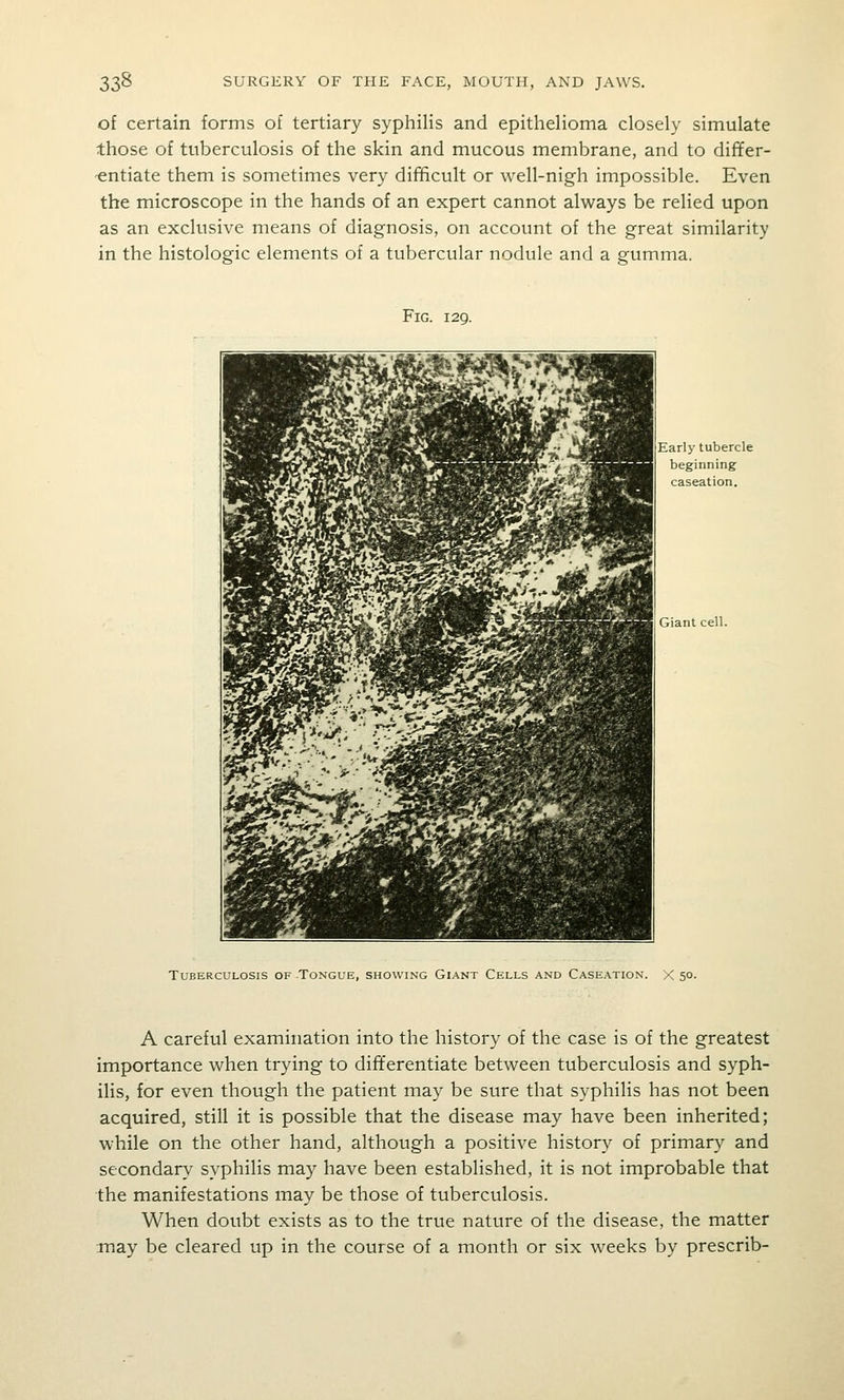 of certain forms of tertiary syphilis and epithelioma closely simulate those of tuberculosis of the skin and mucous membrane, and to dififer- -entiate them is sometimes very difficult or well-nigh impossible. Even the microscope in the hands of an expert cannot always be relied upon as an exclusive means of diagnosis, on account of the great similarity in the histologic elements of a tubercular nodule and a gumma. Fig. 129. Early tubercle beginning caseation. Giant cell. Tuberculosis of Tongue, showing Giant Cells and Caseation. X 50. A careful examination into the history of the case is of the greatest importance when trying to differentiate between tuberculosis and syph- ilis, for even though the patient may be sure that syphilis has not been acquired, still it is possible that the disease may have been inherited; while on the other hand, although a positive history of primary and secondary syphilis may have been established, it is not improbable that the manifestations may be those of tuberculosis. When doubt exists as to the true nature of the disease, the matter may be cleared up in the course of a month or six weeks by prescrib-