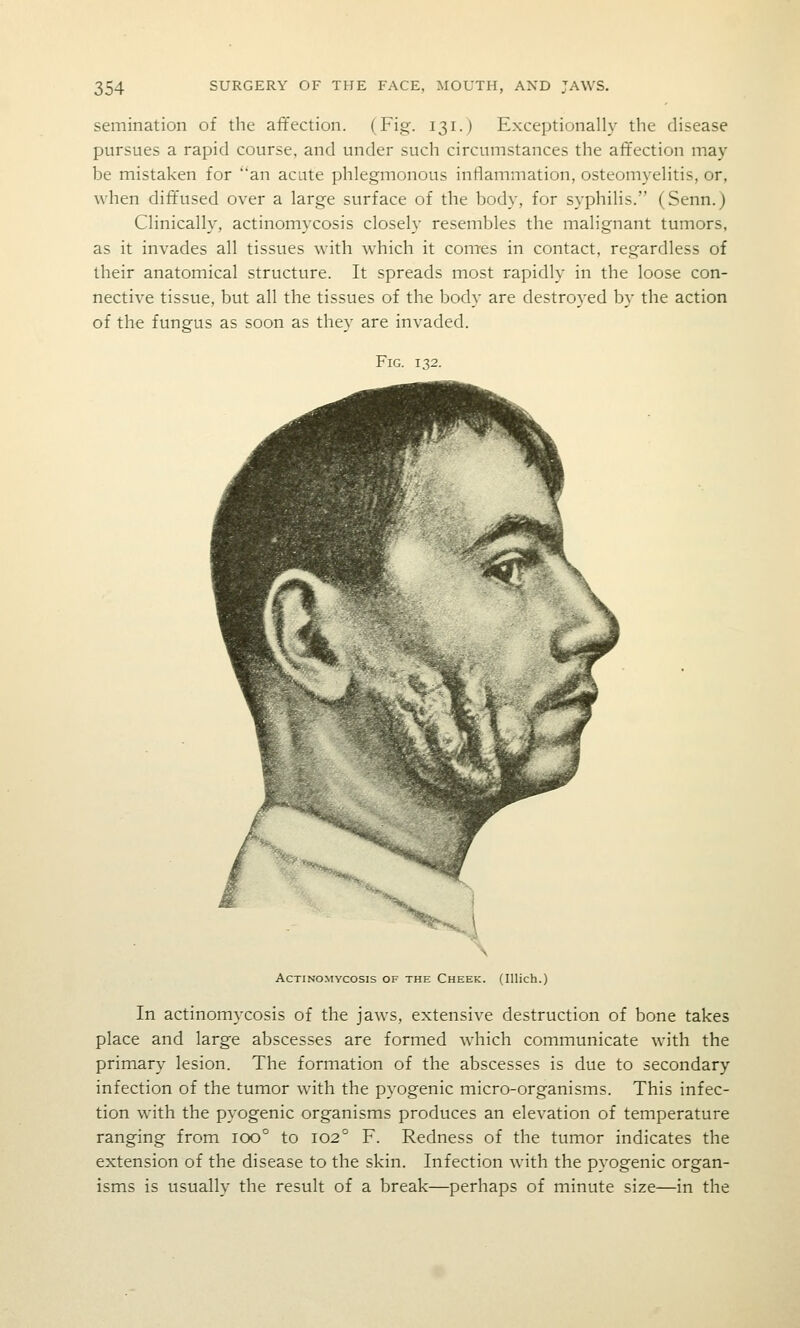 semination of the affection. (Fig. 131.) Exceptionally the disease pursues a rapid course, and under such circumstances the affection may be mistaken for an acute phlegmonous inflammation, osteomyelitis, or, when diffused over a large surface of the body, for syphilis. (Senn.) Clinically, actinomycosis closely resembles the malignant tumors, as it invades all tissues with which it conTes in contact, regardless of their anatomical structure. It spreads most rapidly in the loose con- nective tissue, but all the tissues of the body are destroyed by the action of the fungus as soon as they are invaded. Fig. 132. ACTINO.MYCOSIS OF THE ChEEK. (Illich.) In actinomycosis of the jaws, extensive destruction of bone takes place and large abscesses are formed which communicate with the primary lesion. The formation of the abscesses is due to secondary infection of the tumor with the pyogenic micro-organisms. This infec- tion with the pyogenic organisms produces an elevation of temperature ranging from 100° to 102° F. Redness of the tumor indicates the extension of the disease to the skin. Infection with the pyogenic organ- isms is usually the result of a break—perhaps of minute size—in the