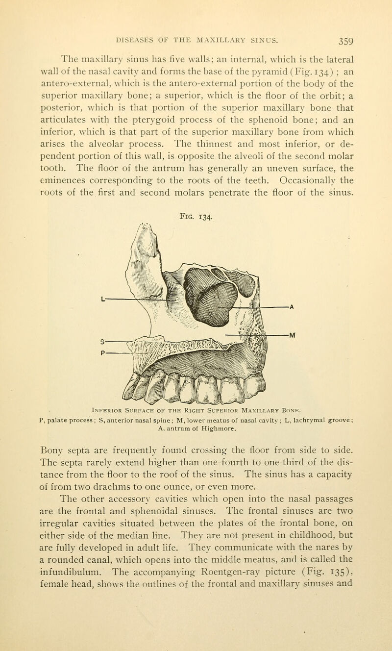 The maxillary sinus has five walls; an internal, which is the lateral wall of the nasal cavity and forms the base of the pyramid (Fio^. 134) ; an antero-external, which is the antero-external portion of the body of the superior maxillary bone; a superior, which is the floor of the orbit; a posterior, which is that portion of the superior maxillary bone that articulates with the pterygoid process of the sphenoid bone; and an inferior, which is that part of the superior maxillary bone from which arises the alveolar process. The thinnest and most inferior, or de- pendent portion of this wall, is opposite the alveoli of the second molar tooth. The floor of the antrum has generally an uneven surface, the eminences corresponding to the roots of the teeth. Occasionally the roots of the first and second molars penetrate the floor of the sinus. Fig. 134. Inferior Surface of the Right Superior Maxillary Bone. P, palate process ; S, anterior nasal spine ; M, lower meatus of nasal cavity ; L, lachrymal groove ; A, antrum of Highmore. Bony septa are frequently found crossing the floor from side to side. The septa rarely extend higher than one-fourth to one-third of the dis- tance from the floor to the roof of the sinus. The sinus has a capacity of from two drachms to one ounce, or even more. The other accessory cavities which open into the nasal passages are the frontal and sphenoidal sinuses. The frontal sinuses are two irregular cavities situated between the plates of the frontal bone, on either side of the median line. They are not present in childhood, but are fully developed in adult life. They communicate with the nares by a rounded canal, which opens into the middle meatus, and is called the infundibulum. The accompanying Roentgen-ray picture (Fig. 135), female head, shows the outlines of the frontal and maxillary sinuses and