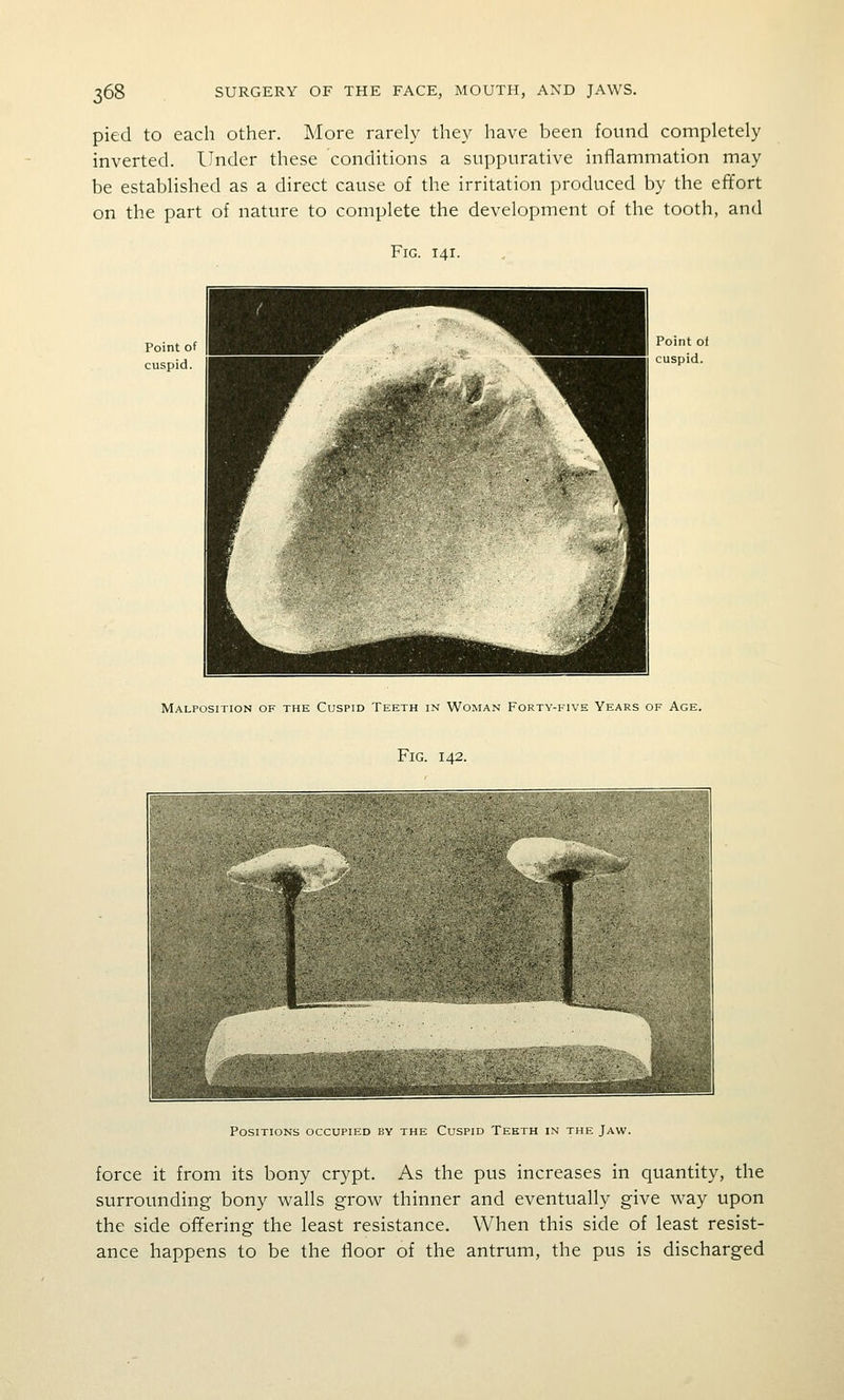 pied to each other. More rarely they have been found completely inverted. Under these conditions a suppurative inflammation may be established as a direct cause of the irritation produced by the effort on the part of nature to complete the development of the tooth, and Fig. 141. Malposition of the Cuspid Teeth in Woman Forty-five Years of Age. Fig. 142. Positions occupied by the Cuspid Teeth in the Jaw. force it from its bony crypt. As the pus increases in quantity, the surrounding bony walls grow thinner and eventually give way upon the side offering the least resistance. When this side of least resist- ance happens to be the floor of the antrum, the pus is discharged