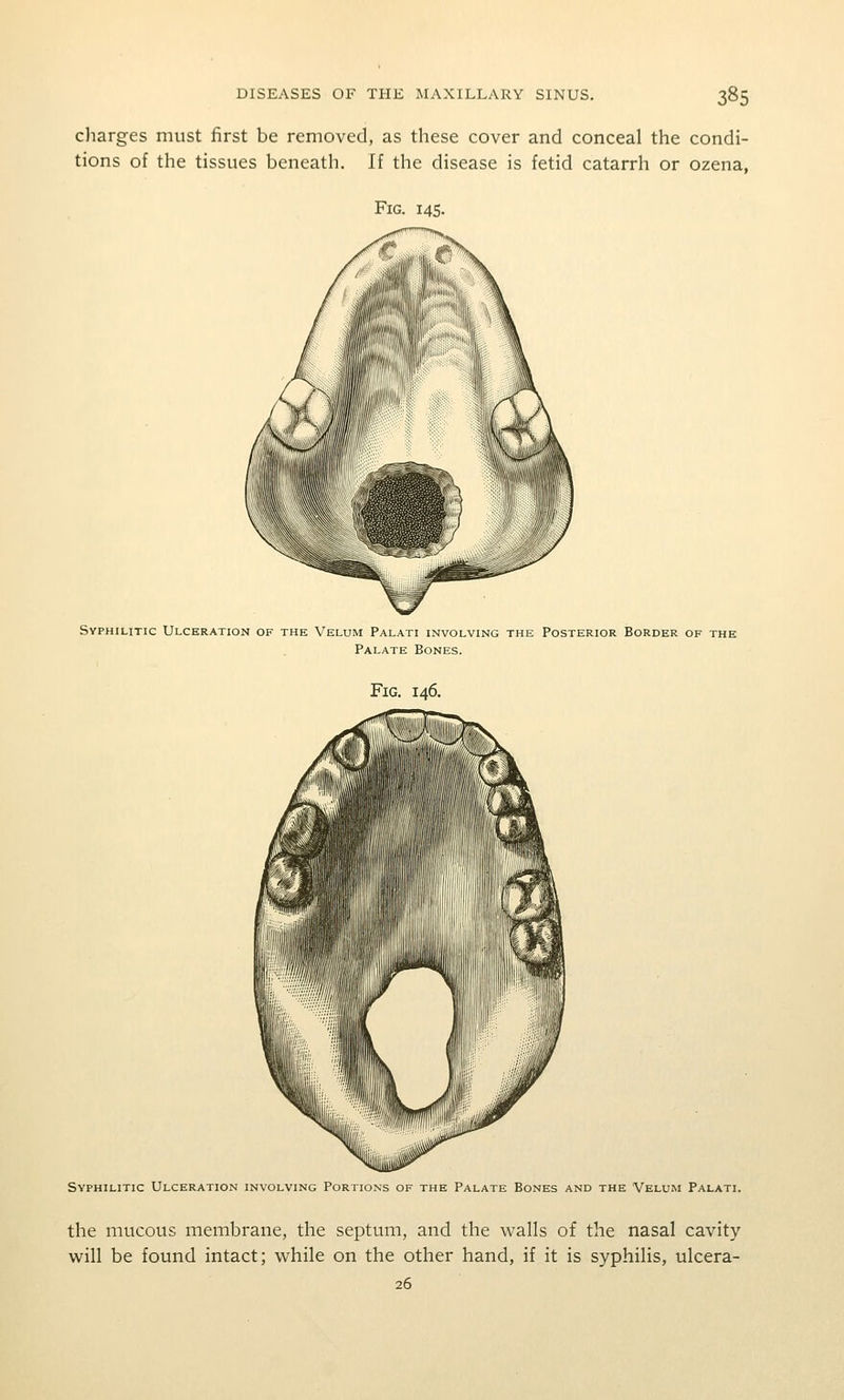 charges must first be removed, as these cover and conceal the condi- tions of the tissues beneath. If the disease is fetid catarrh or ozena, Fig. 145. Syphilitic Ulceration of the Velum Palati involving the Posterior Border of the Palate Bones. Fig. 146. Syphilitic Ulceration involving Portions of the Palate Bones and the Velum Palati. the mucous membrane, the septum, and the walls of the nasal cavity will be found intact; while on the other hand, if it is syphilis, ulcera- 26