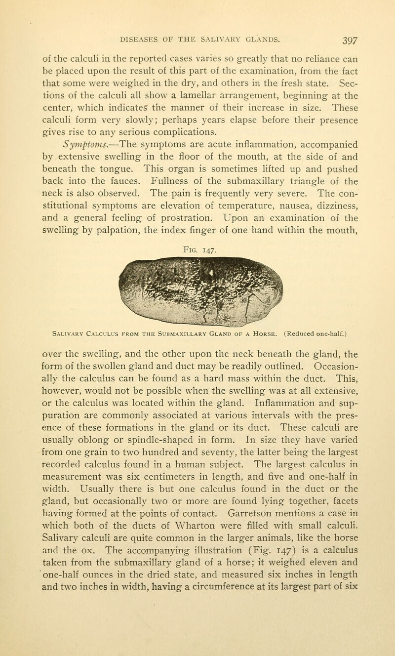 of the calculi in the reported cases varies so greatly that no reliance can be placed upon the result of this part of the examination, from the fact that some were weighed in the dry, and others in the fresh state. Sec- tions of the calculi all show a lamellar arrangement, beginning at the center, which indicates the manner of their increase in size. These calculi form very slowly; perhaps years elapse before their presence gives rise to any serious complications. Symptoms.—^The symptoms are acute inflammation, accompanied by extensive swelling in the floor of the mouth, at the side of and beneath the tongue. This organ is sometimes lifted up and pushed back into the fauces. Fullness of the submaxillary triangle of the neck is also observed. The pain is frequently very severe. The con- stitutional symptoms are elevation of temperature, nausea, dizziness, and a general feeling of prostration. Upon an examination of the swelling by palpation, the index finger of one hand within the mouth, Fig. 147. Salivary Calculus from the Submaxillary Gland of a Horse. (Reduced one-half.) over the swelling, and the other upon the neck beneath the gland, the form of the swollen gland and duct may be readily outlined. Occasion- ally the calculus can be found as a hard mass within the duct. This, however, would not be possible when the swelling was at all extensive, or the calculus was located within the gland. Inflammation and sup- puration are commonly associated at various intervals with the pres- ence of these formations in the gland or its duct. These calculi are usually oblong or spindle-shaped in form. In size they have varied from one grain to two hundred and seventy, the latter being the largest recorded calculus found in a human subject. The largest calculus in measurement was six centimeters in length, and five and one-half in width. Usually there is but one calculus found in the duct or the gland, but occasionally two or more are found lying together, facets having formed at the points of contact. Garretson mentions a case in which both of the ducts of Wharton were filled with small calculi. Salivary calculi are quite common in the larger animals, like the horse and the ox. The accompanying illustration (Fig. 147) is a calculus taken from the submaxillary gland of a horse; it weighed eleven and one-half ounces in the dried state, and measured six inches in length and two inches in width, having a circumference at its largest part of six