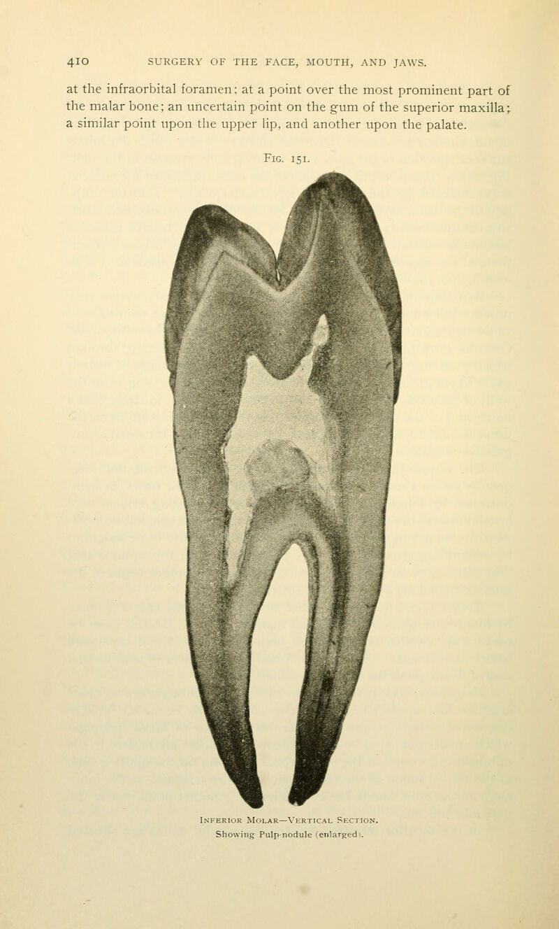 at the infraorbital foramen; at a point over the most prominent part of the malar bone; an uncertain point on the gum of the superior maxilla^ a similar point upon the upper lip, and another upon the palate. Fig. 151. Inferior Moi.ar—\'ertical Section. Showing Pulp-nodule (eiilargedi.