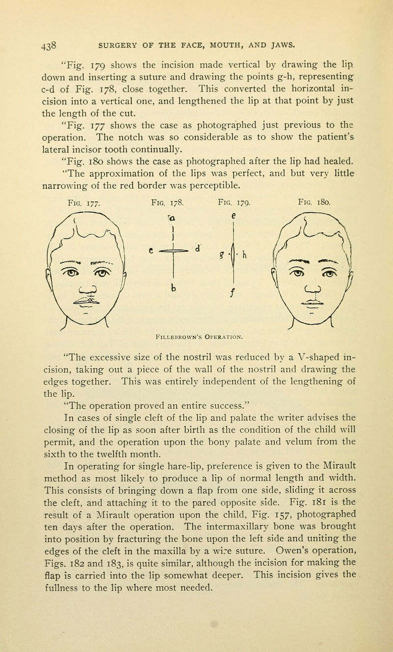 Fig. 179 shows the incision made vertical by drawing the hp, down and inserting a suture and drawing the points g-h, representing c-d of Fig. 178, close together. This converted the horizontal in- cision into a vertical one, and lengthened the lip at that point by just the length of the cut. Fig. 177 shows the case as photographed just previous to the operation. The notch was so considerable as to show the patient's lateral incisor tooth continually. Fig. 180 shows the case as photographed after the lip had healed. The approximation of the lips was perfect, and but very little narrowing of the red border was perceptible. Fig. 177. Fig. 178. fa I c -= =» a Fig. 179. e ? • Fig. 180. Fillebrown's Operation. The excessive size of the nostril was reduced by a V-shaped in- cision, taking out a piece of the wall of the nostril and drawing the edges together. This was entirely independent of the lengthening of the lip. The operation proved an entire success. In cases of single cleft of the lip and palate the writer advises the closing of the lip as soon after birth as the condition of the child will permit, and the operation upon the bony palate and velum from the sixth to the twelfth month. In operating for single hare-lip, preference is given to the Mirault method as most likely to produce a lip of normal length and width. This consists of bringing down a flap from one side, sliding it across the cleft, and attaching it to the pared opposite side. Fig. 181 is the result of a Mirault operation upon the child. Fig. 157, photographed ten days after the operation. The intermaxillary bone was brought into position by fracturing the bone upon the left side and uniting the edges of the cleft in the maxilla by a wire suture. Owen's operation, Figs. 182 and 183, is quite similar, although the incision for making the flap is carried into the lip somewhat deeper. This incision gives the fullness to the lip where most needed.