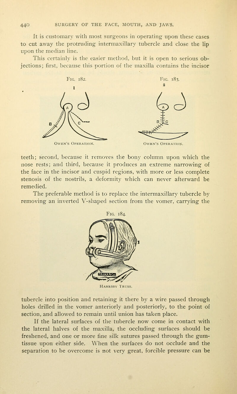 It is customary with most surgeons in operating upon these cases to cut away the protruding intermaxillary tubercle and close the lip upon the median line. This certainly is the easier method, but it is open to serious ob- jections; first, because this portion of the maxilla contains the incisor Fig. 182. Fig. 18,1. Owen's Operation. Owen's Operation. teeth; second, because it removes the bony column upon which the nose rests; and third, because it produces an extreme narrowing of the face in the incisor and cuspid regions, with more or less complete stenosis of the nostrils, a deformity which can never afterward be remedied. The preferable method is to replace the intermaxillary tubercle by removing an inverted V-shaped section from the vomer, carrying the Fig. 184. Hanesby Truss. tubercle into position and retaining it there by a wire passed through holes drilled in the vomer anteriorly and posteriorly, to the point of section, and allowed to remain until union has taken place. If the lateral surfaces of the tubercle now come in contact with the lateral halves of the maxilla, the occluding surfaces should be freshened, and one or more fine silk sutures passed through the gum- tissue upon either side. When the surfaces do not occlude and the separation to be overcome is not very great, forcible pressure can be