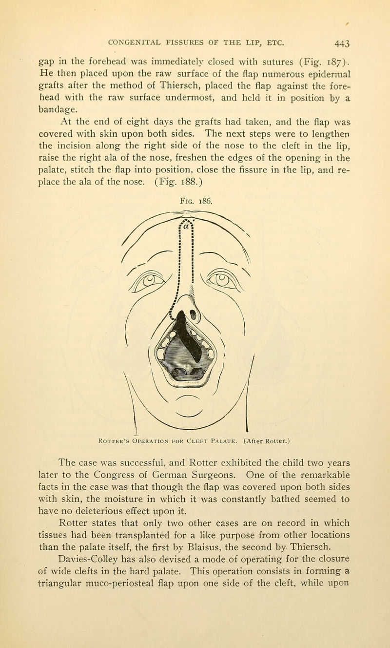 gap in the forehead was immediately closed with sutures (Fig. 187). He then placed upon the raw surface of the flap numerous epidermal grafts after the method of Thiersch, placed the flap against the fore- head with the raw surface undermost, and held it in position by a bandage. At the end of eight days the grafts had taken, and the flap was covered with skin upon both sides. The next steps were to lengthen the incision along the right side of the nose to the cleft in the lip, raise the right ala of the nose, freshen the edges of the opening in the palate, stitch the flap into position, close the fissure in the lip, and re- place the ala of the nose. (Fig. 188.) Fig. 186. Rotter's Operation for Cleft Palate. (Afier Roller.) The case was successful, and Rotter exhibited the child two years later to the Congress of German Surgeons. One of the remarkable facts in the case was that though the flap was covered upon both sides with skin, the moisture in which it was constantly bathed seemed to have no deleterious effect upon it. Rotter states that only two other cases are on record in which tissues had been transplanted for a like purpose from other locations than the palate itself, the first by Blaisus, the second by Thiersch. Davies-Colley has also devised a mode of operating for the closure of wide clefts in the hard palate. This operation consists in forming a triangular muco-periosteal flap upon one side of the cleft, while upon