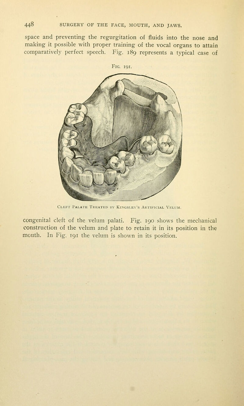 Space and preventing the regurgitation of fluids into the nose and making it possible with proper training of the vocal organs to attain comparatively perfect speech. Fig. 189 represents a typical case of Fig. 191. Cleft Palate Treated by Kingslev's Artificial Velum. congenital cleft of the velum palati. Fig. 190 shows the mechanical construction of the velum and plate to retain it in its position in the mouth. In Fig. 191 the velum is shown in its position.