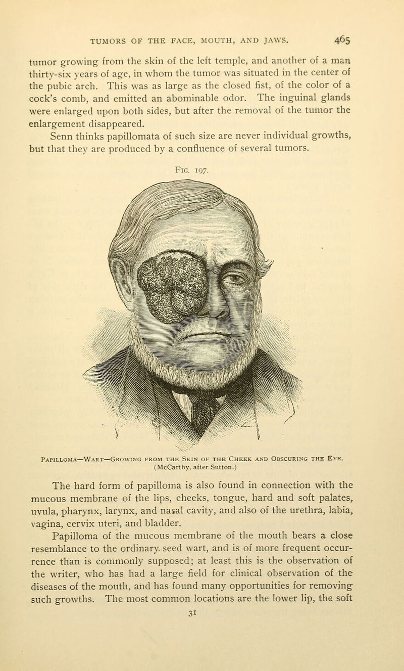 tumor growing from the skin of the left temple, and another of a man thirty-six years of age, in whom the tumor was situated in the center of the pubic arch. This was as large as the closed fist, of the color of a cock's comb, and emitted an abominable odor. The inguinal glands were enlarged upon both sides, but after the removal of the tumor the enlargement disappeared. Senn thinks papillomata of such size are never individual growths, but that they are produced by a confluence of several tumors. Fig. 197. Papilloma—Wart—Growing from the Skin of the Cheek and Obscuring the Eye. (McCarthy, after Sutton.) The hard form of papilloma is also found in connection with the mucous membrane of the lips, cheeks, tongue, hard and soft palates, uvula, pharynx, larynx, and nasal cavity, and also of the urethra, labia, vagina, cervix uteri, and bladder. Papilloma of the mucous membrane of the mouth bears a close resemblance to the ordinary- seed wart, and is of more frequent occur- rence than is commonly supposed; at least this is the observation of the writer, who has had a large field for clinical observation of the diseases of the mouth, and has found many opportunities for removing such growths. The most common locations are the lower lip, the soft 31