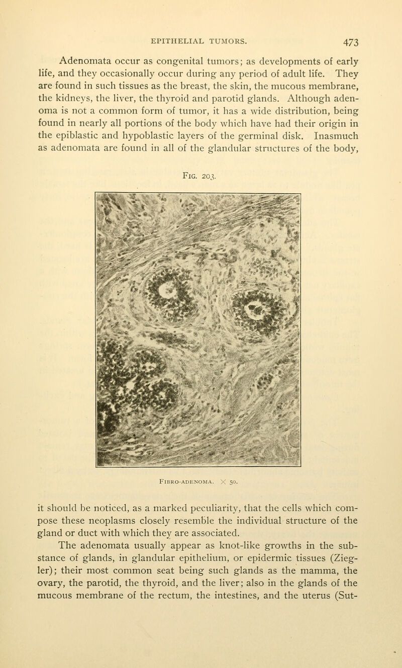 Adenomata occur as congenital tumors; as developments of early life, and they occasionally occur during any period of adult life. They are found in such tissues as the breast, the skin, the mucous membrane, the kidneys, the liver, the thyroid and parotid glands. Although aden- oma is not a common form of tumor, it has a wide distribution, being found in nearly all portions of the body which have had their origin in the epiblastic and hypoblastic layers of the germinal disk. Inasmuch as adenomata are found in all of the glandular structures of the body, Fig. 203. FiBRO-ADENOMA. X' 50. it should be noticed, as a marked peculiarity, that the cells which com- pose these neoplasms closely resemble the individual structure of the gland or duct with which they are associated. The adenomata usually appear as knot-like growths in the sub- stance of glands, in glandular epithelium, or epidermic tissues (Zieg- ler); their most common seat being such glands as the mamma, the ovary, the parotid, the thyroid, and the liver; also in the glands of the mucous membrane of the rectum, the intestines, and the uterus (Sut-