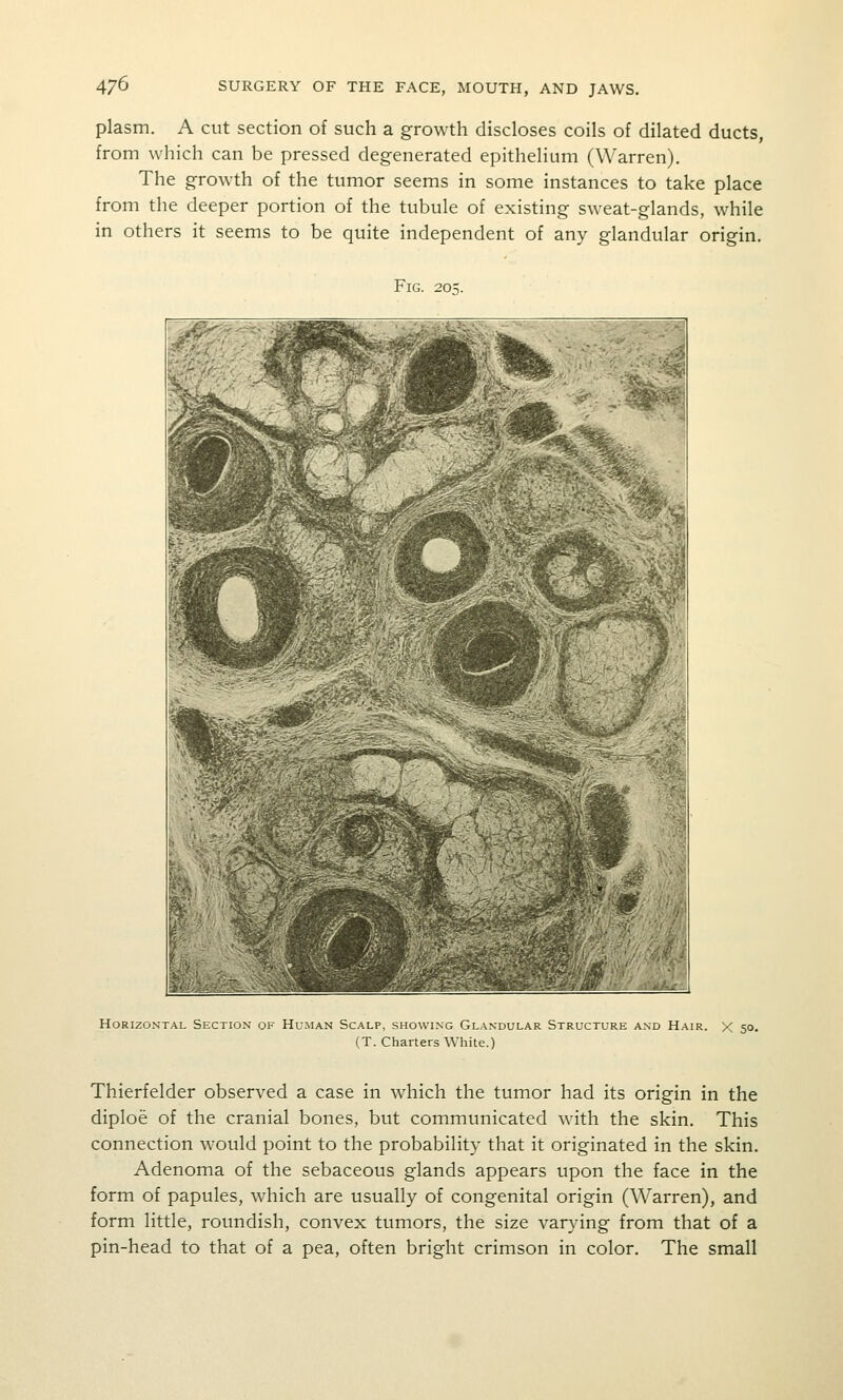 plasm. A cut section of such a growth discloses coils of dilated ducts, from which can be pressed degenerated epitheliimi (Warren). The growth of the tumor seems in some instances to take place from the deeper portion of the tubule of existing sweat-glands, while in others it seems to be quite independent of any glandular origin. Fig. 205. Horizontal Section of Human Scalp, showing Glandular Structure and Hair. X 50. (T. Charters White.) Thierfelder observed a case in which the tumor had its origin in the diploe of the cranial bones, but communicated with the skin. This connection would point to the probability that it originated in the skin. Adenoma of the sebaceous glands appears upon the face in the form of papules, which are usually of congenital origin (Warren), and form little, roundish, convex tumors, the size varying from that of a pin-head to that of a pea, often bright crimson in color. The small