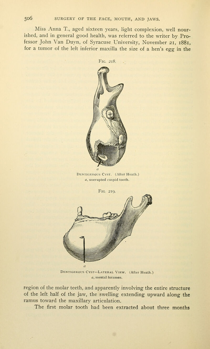 Miss Anna T,, aged sixteen years, light complexion, well nour- ished, and in general good health, was referred to the writer by Pro- fessor John Van Duyn, of Syracuse University, November 21, 1881, for a tumor of the left inferior maxilla the size of a hen's egg in the Fig. 218. Dentigerous Cyst. (After Heath.) a, unerupted cuspid tooth. Fig. 219. Dentigerous Cyst—Lateral View. (After Heath.) a, mental foramen. region of the molar teeth, and apparently involving the entire structure of the left half of the jaw, the swelling extending upward along the ramus toward the maxillary articulation. The first molar tooth had been extracted about three months