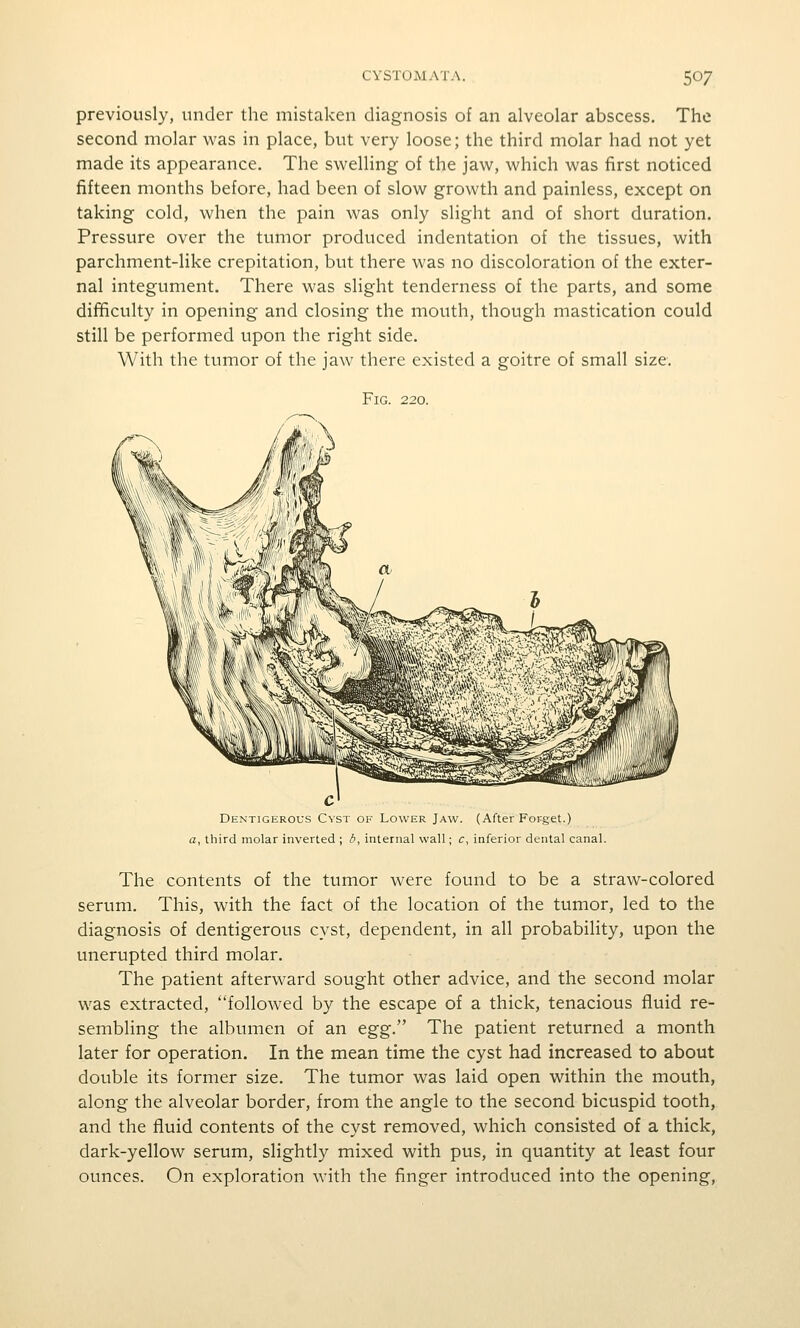 previously, under the mistaken diagnosis of an alveolar abscess. The second molar was in place, but very loose; the third molar had not yet made its appearance. The swelling of the jaw, which was first noticed fifteen months before, had been of slow growth and painless, except on taking cold, when the pain was only slight and of short duration. Pressure over the tumor produced indentation of the tissues, with parchment-like crepitation, but there was no discoloration of the exter- nal integument. There was slight tenderness of the parts, and some difficulty in opening and closing the mouth, though mastication could still be performed upon the right side. With the tumor of the jaw there existed a goitre of small size. Fig. 220. Dentigerous Cyst of Lower Jaw. (After For-get.) a, third molar inverted ; b, internal wall; c^ inferior dental canal. The contents of the tumor were found to be a straw-colored serum. This, with the fact of the location of the tumor, led to the diagnosis of dentigerous cyst, dependent, in all probability, upon the unerupted third molar. The patient afterward sought other advice, and the second molar was extracted, followed by the escape of a thick, tenacious fluid re- sembling the albumen of an t^g. The patient returned a month later for operation. In the mean time the cyst had increased to about double its former size. The tumor was laid open within the mouth, along the alveolar border, from the angle to the second bicuspid tooth, and the fluid contents of the cyst removed, which consisted of a thick, dark-yellow serum, slightly mixed with pus, in quantity at least four ounces. On exploration with the finger introduced into the opening,