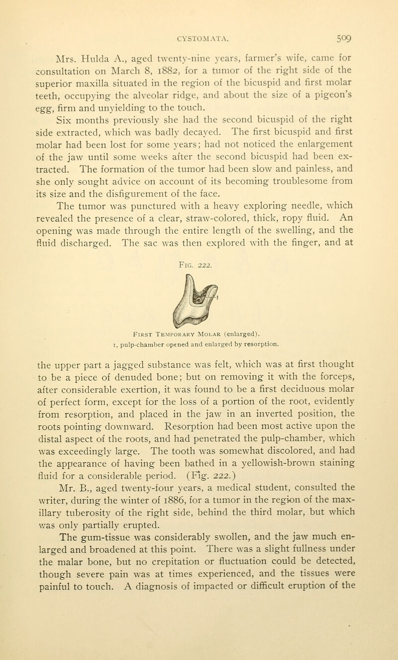 Mrs. Hulda A., aged twenty-nine years, farmer's wife, came for consultation on March 8, 1882, for a tumor of the right side of the superior maxilla situated in the region of the bicuspid and first molar teeth, occupying the alveolar ridge, and about the size of a pigeon's egg, firm and unyielding to the touch. Six months previously she had the second bicuspid of the right side extracted, which was badly decayed. The first bicuspid and first molar had been lost for some years; had not noticed the enlargement of the jaw until some weeks after the second bicuspid had been ex- tracted. The formation of the tumor had been slow and painless, and she only sought advice on account of its becoming troublesome from its size and the disfigurement of the face. The tumor was punctured with a heavy exploring needle, which revealed the presence of a clear, straw-colored, thick, ropy fluid. An opening was made through the entire length of the swelling, and the fluid discharged. The sac was then explored with the finger, and at Fig. 222. First Temporary Molar (enlarged). I, pulp-chamber opened and enlarged by resorption. the upper part a jagged substance was felt, which was at first thought to be a piece of denuded bone; but on removing it with the forceps, after considerable exertion, it was found to be a first deciduous molar of perfect form, except for the loss of a portion of the root, evidently from resorption, and placed in the jaw in an inverted position, the roots pointing downward. Resorption had been most active upon the distal aspect of the roots, and had penetrated the pulp-chamber, which was exceedingly large. The tooth was somewhat discolored, and had the appearance of having been bathed in a yellowish-brown staining fluid for a considerable period. (Fig. 222.) Mr. B., aged twenty-four years, a medical student, consulted the writer, during the winter of 1886, for a tumor in the region of the max- illary tuberosity of the right side, behind the third molar, but which v.^as only partiall}^ erupted. The gum-tissue was considerably swollen, and the jaw much en- larged and broadened at this point. There was a slight fullness under the malar bone, but no crepitation or fluctuation could be detected, though severe pain was at times experienced, and the tissues were painful to touch. A diagnosis of impacted or difficult eruption of the