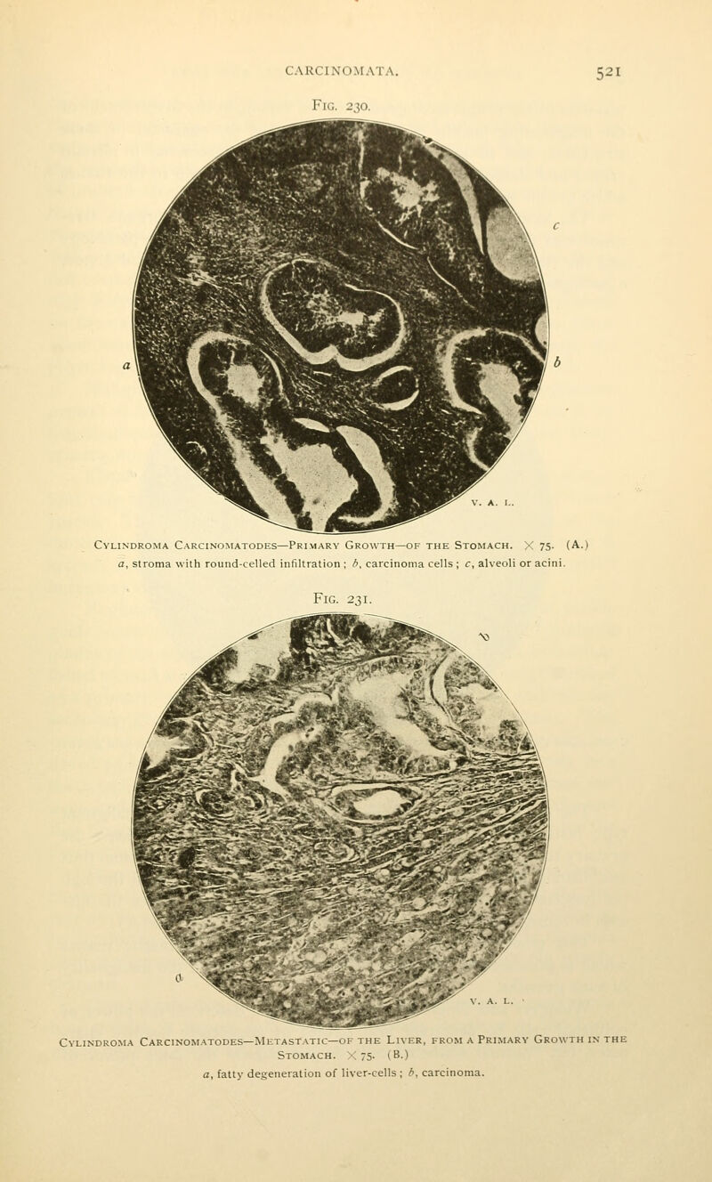 Fig. 230. 521 Cylindroma Carcinomatodes—Primary Growth—of the Stomach. X 75. (A.) a, stroma with round-celled infiltration ; b, carcinoma cells ; c, alveoli or acini. Fig. 231. Cylindroma Carcinomatodes—Metastatic—of the Liver, from a Primary Growth in the Stomach. X 75- (B.) a, fatty degeneration of liver-cells ; b, carcinoma.