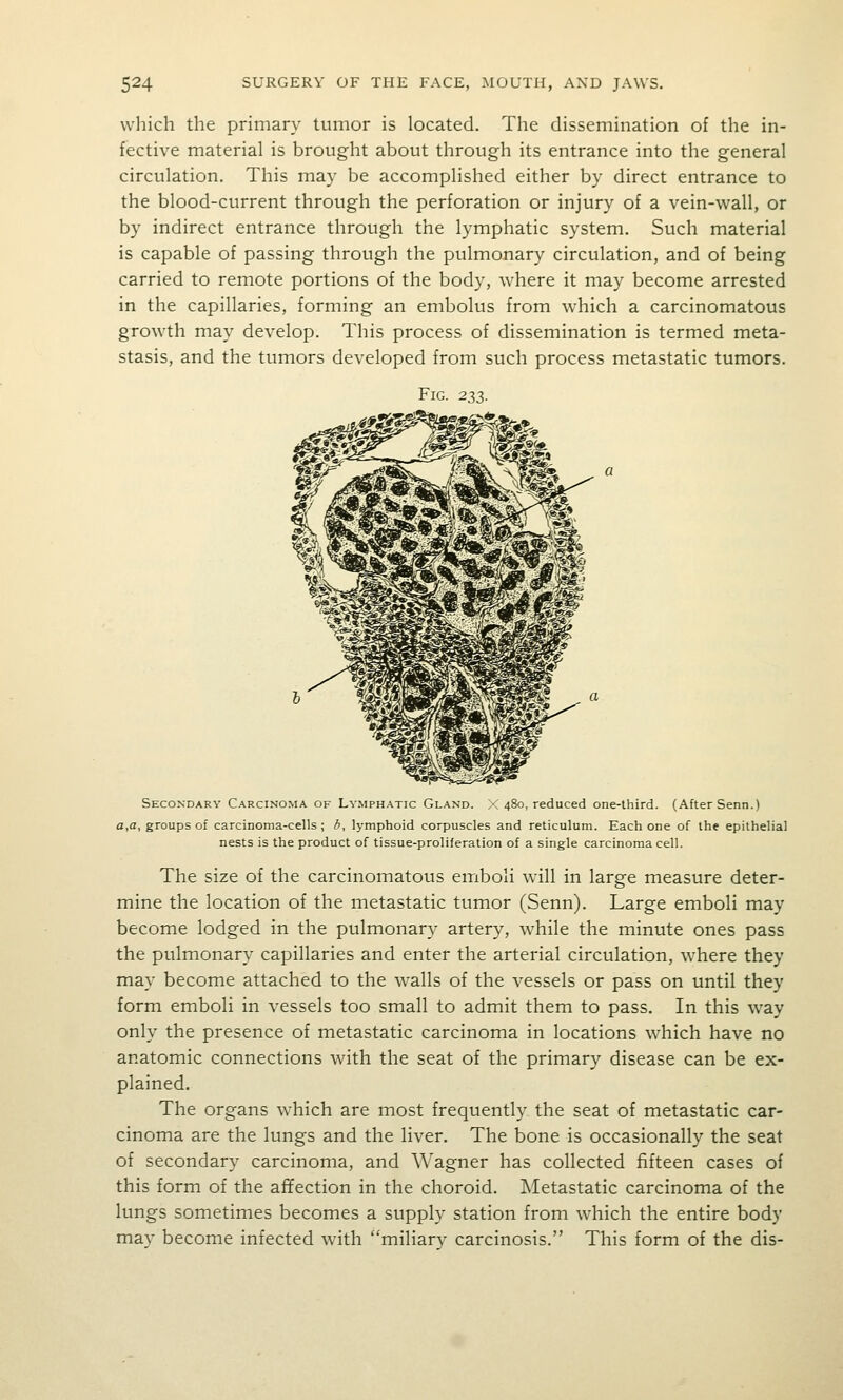 which the primary tumor is located. The dissemination of the in- fective material is brought about through its entrance into the general circulation. This may be accomplished either by direct entrance to the blood-current through the perforation or injury of a vein-wall, or by indirect entrance through the lymphatic system. Such material is capable of passing through the pulmonary circulation, and of being carried to remote portions of the body, where it may become arrested in the capillaries, forming an embolus from which a carcinomatous growth may develop. This process of dissemination is termed meta- stasis, and the tumors developed from such process metastatic tumors. Fig. 233. Secondary Carcinoma of Lymphatic Gland. :< 480, reduced one-third. (After Senn.) a,a, groups of carcinoma-cells; b, lymphoid corpuscles and reticulum. Each one of the epithelial nests is the product of tissue-proliferation of a single carcinoma cell. The size of the carcinomatous emboli will in large measure deter- mine the location of the metastatic tumor (Senn). Large emboli may become lodged in the pulmonary artery, while the minute ones pass the pulmonary capillaries and enter the arterial circulation, where they may become attached to the walls of the vessels or pass on until they form emboli in vessels too small to admit them to pass. In this way only the presence of metastatic carcinoma in locations which have no anatomic connections with the seat of the primary disease can be ex- plained. The organs which are most frequently the seat of metastatic car- cinoma are the lungs and the liver. The bone is occasionally the seat of secondary carcinoma, and Wagner has collected fifteen cases of this form of the affection in the choroid. Metastatic carcinoma of the lungs sometimes becomes a supply station from which the entire body may become infected with miliarv carcinosis. This form of the dis-