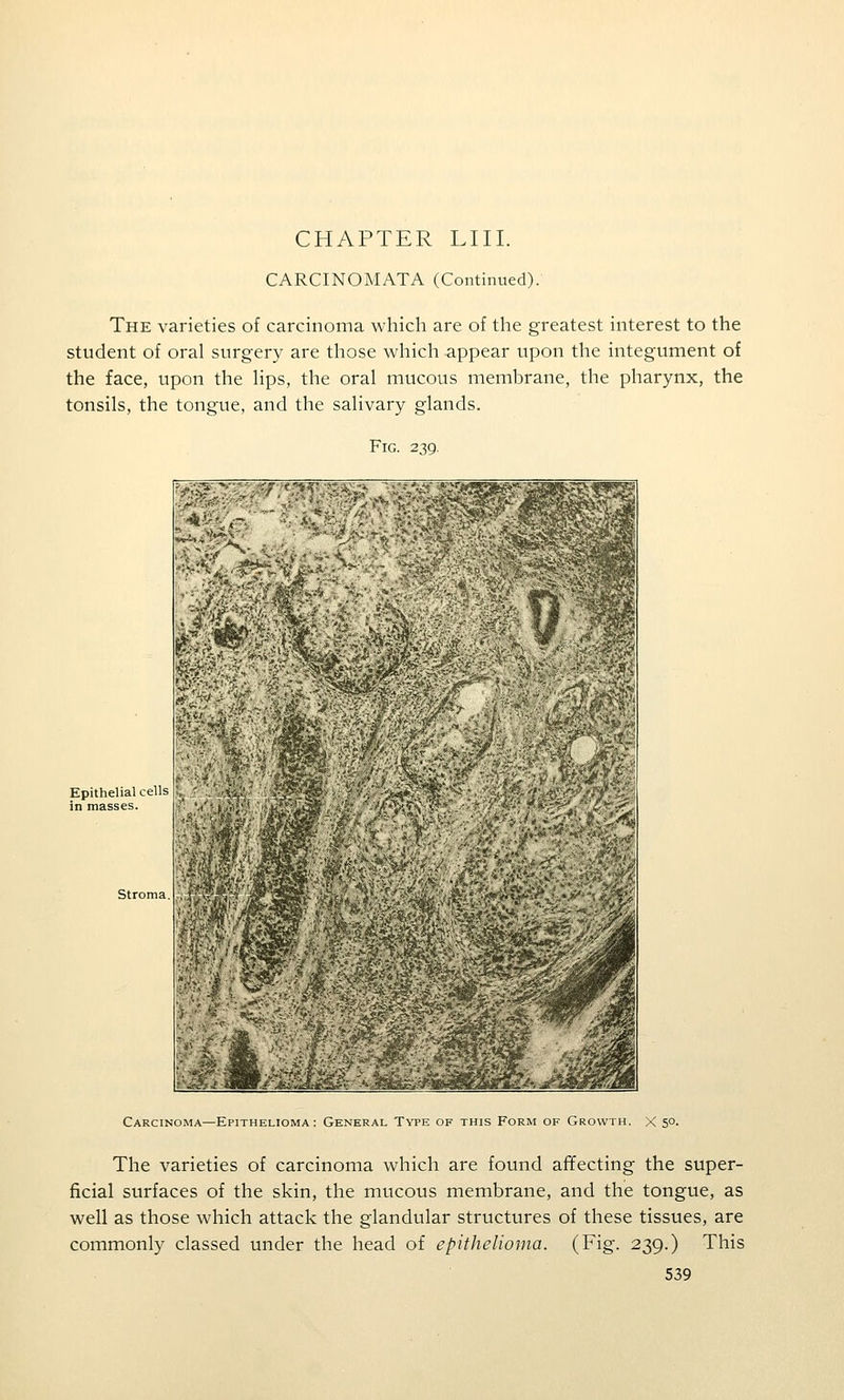 CHAPTER LIII. CARCINOMATA (Continued). The varieties of carcinoma which are of the greatest interest to the student of oral surgery are those which appear upon the integument of the face, upon the hps, the oral mucous membrane, the pharynx, the tonsils, the tongue, and the salivary glands. Epithelial cells in masses. Stroma Carcinoma—Epithelioma: General Type of this Form of Growth. X 5° The varieties of carcinoma which are found afifecting the super- ficial surfaces of the skin, the mucous membrane, and the tongue, as well as those which attack the glandular structures of these tissues, are commonly classed under the head of epithelioma. (Fig. 239.) This