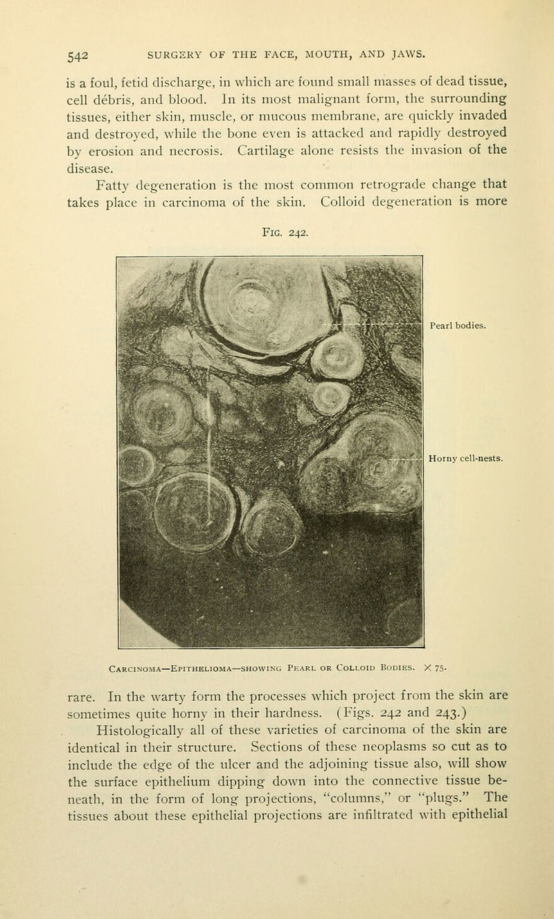 is a foul, fetid discharge, in which are found small masses of dead tissue, cell debris, and blood. In its most malignant form, the surrounding tissues, either skin, muscle, or mucous membrane, are quickly invaded and destroyed, while the bone even is attacked and rapidly destroyed by erosion and necrosis. Cartilage alone resists the invasion of the disease. Fatty degeneration is the most common retrograde change that takes place in carcinoma of the skin. Colloid degeneration is more Fig. 242. Pearl bodies. Horny cell-nests. Carcinoma—Epithelioma—SHOWING Pearl or Colloid Bodies. X 75- rare. In the warty form the processes which project from the skin are sometimes quite horny in their hardness. (Figs. 242 and 243.) Histologically all of these varieties of carcinoma of the skin are identical in their structure. Sections of these neoplasms so cut as to include the edge of the ulcer and the adjoining tissue also, will show the surface epithelium dipping down into the connective tissue be- neath, in the form of long projections, columns, or plugs. The tissues about these epithelial projections are infiltrated with epithelial