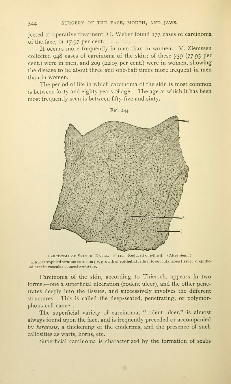 jected to operative treatment, O. Weber found 133 cases of carcinoma of the face, or 17.97 per cent. It occurs more frequently in men than in women. V. Ziemssen collected 948 cases of carcinoma of the skin; of these 739 (77.95 per cent.) were in men, and 209 (22;05 per cent.) were in women, showing the disease to be about three and one-half times more frequent in men than in women. The period of life in which carcinoma of the skin is most common is between forty and eighty years of age. The age at which it has been most frequently seen is between fifty-five and sixty. Fig. 244. Carcinoma OF Skin OF Nates. X ho. Reduced one-third. (After Senn.) a, hypertrophied stratum corneum; ^i, growth of epithelial cells into subcutaneous tissue ; c, epithe- lial nest in vascular connective-tissue. Carcinoma of the skin, according to Thiersch, appears in two forms,—one a superficial ulceration (rodent ulcer), and the other pene- trates deeply into the tissues, and successively involves the different structures. This is called the deep-seated, penetrating, or polymor- phous-cell cancer. The superficial variety of carcinoma, ''rodent ulcer, is almost always found upon the face, and is frequently preceded or accompanied by keratosis, a thickening of the epidermis, and the presence of such callosities as warts, horns, etc. Superficial carcinoma is characterized by the formation of scabs