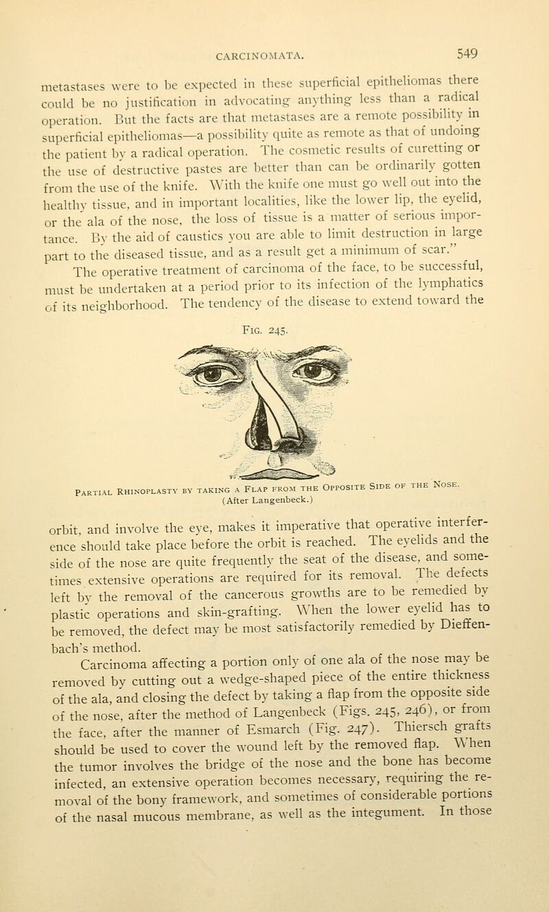 metastases were to be expected in these superficial epitheliomas there could be no justification in advocating anything less than a radical operation. But the facts are that metastases are a remote possibility in superficial epitheliomas—a possibility quite as remote as that of undoing the patient bv a radical operation. The cosmetic results of curetting or the use of destructive pastes are better than can be ordinarily gotten from the use of the knife. With the knife one must go well out into the healthy tissue, and in important localities, like the lower lip, the eyelid, or the ala of the nose, the loss of tissue is a matter of serious impor- tance. Bv the aid of caustics you are able to limit destruction in hrge part to the diseased tissue, and as a result get a minimum of scar. The operative treatment of carcinoma of the face, to be successful, must be undertaken at a period prior to its infection of the lymphatics of its neighborhood. The tendency of the disease to extend toward the Fig. 245. Partial Rhinoplasty by taking a Flap from the Opposite Side of the Nose. (After Langenbeck.) orbit, and involve the eve, makes it imperative that operative interfer- ence should take place before the orbit is reached. The eyelids and the side of the nose are quite frequently the seat of the disease, and some- times extensive operations are required for its removal. The defects left bv the removal of the cancerous growths are to be remedied by plastic operations and skin-grafting. When the lower eyelid has to be removed, the defect may be most satisfactorily remedied by Dieffen- bach's method. Carcinoma affecting a portion only of one ala of the nose may be removed by cutting out a wedge-shaped piece of the entire thickness of the ala, and closing the defect by taking a flap from the opposite side of the nose, after the method of Langenbeck (Figs. 245. 246), or from the face, after the manner of Esmarch (Fig. 247)- Thiersch grafts should be used to cover the wound left by the removed flap. Wlien the tumor involves the bridge of the nose and the bone has become infected, an extensive operation becomes necessary, requiring the re- moval of the bony framework, and sometimes of considerable portions of the nasal mucous membrane, as well as the integument. In those