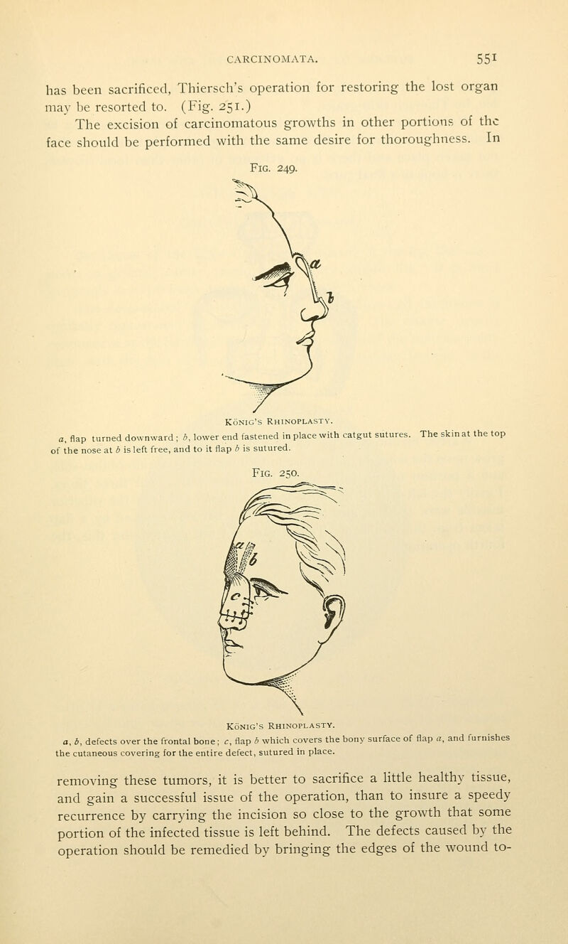 has been sacrificed, Thiersch's operation for restoring the lost organ may be resorted to. (Fig. 251.) The excision of carcinomatous growths in other portions of the face should be performed with the same desire for thoroughness. In Fig. 249. Konig's Rhinoplasty. a, flap turned downward ; b, lower end fastened in place with catgut sutures. The skin at the top of the nose at b is left free, and to it flap b is sutured. Fig. 250. Konig's Rhinoplasty. a, b, defects over the frontal bone; c, flap b which covers the bony surface of flap a, and furnishes the cutaneous covering for the entire defect, sutured in place. removing these tumors, it is better to sacrifice a little healthy tissue, and gain a successful issue of the operation, than to insure a speedy recurrence by carrying the incision so close to the growth that some portion of the infected tissue is left behind. The defects caused by the operation should be remedied by bringing the edges of the wound to-