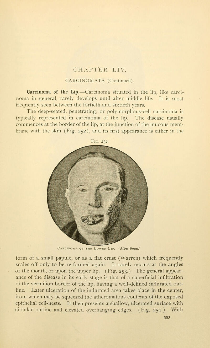 CHAPTER LIV. CARCINOMATA (Continued). Carcinoma of the Lip.—Carcinoma situated in the lip, like carci- noma in general, rarely develops until after middle life. It is most frequently seen between the fortieth and sixtieth years. The deep-seated, penetrating, or polymorphous-cell carcinoma is typically represented in carcinoma of the lip. The disease usually commences at the border of tKe lip, at the junction of the mucous mem- brane with the skin (Fig. 252), and its first appearance is either in the Fig 252. Carcinoma of the Lower Lip. (After Senn.) form of a small papule, or as a flat crust (Warren) which frequently scales off only to be re-formed again. It rarely occurs at the angles of the mouth, or upon the upper lip. (Fig. 253.) The general appear- ance of the disease in its early stage is that of a superficial infiltration of the vermilion border of the lip, having a well-defined indurated out- line. Later ulceration of the indurated area takes place in the center, from which may be squeezed the atheromatous contents of the exposed epithelial cell-nests. It then presents a shallow, ulcerated surface with circular outline and elevated overhanging edges. (Fig. 254.) With