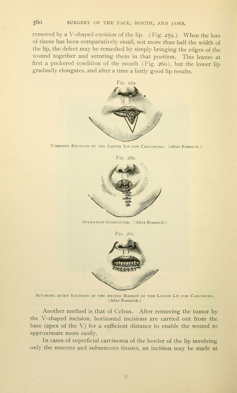 removed by a A'-shaped excision of the lip. (Fig. 259.j When the loss of tissue has been comparatively small, not more than half the width of the lip, the defect may be remedied by simply bringing the edges of the wound together and suturing them in that position. This leaves at first a puckered condition of the mouth (Fig. 260j, but the lower lip gradually elongates, and after a time a fairly good lip results. Fig. 259. V-SHAPED Excision of the Lower Lip for Carcinoma. (After Esmarch.) Fig. 260. Operation Co.mpleted. (After Esmarch.) Fig. 261. Suturing after Excision of the entire Margin of the Lower Lip for Carcinoma. (After Esmarch.) Another method is that of Celsus. After removing the tumor by the V-shaped incision, horizontal incisions are carried out from the base (apex of the V) for a sutificient distance to enable the wound to approximate more easily. In cases of superficial carcinoma of the border of the lip involving only the mucous and submucous tissues, an incision mav be made at