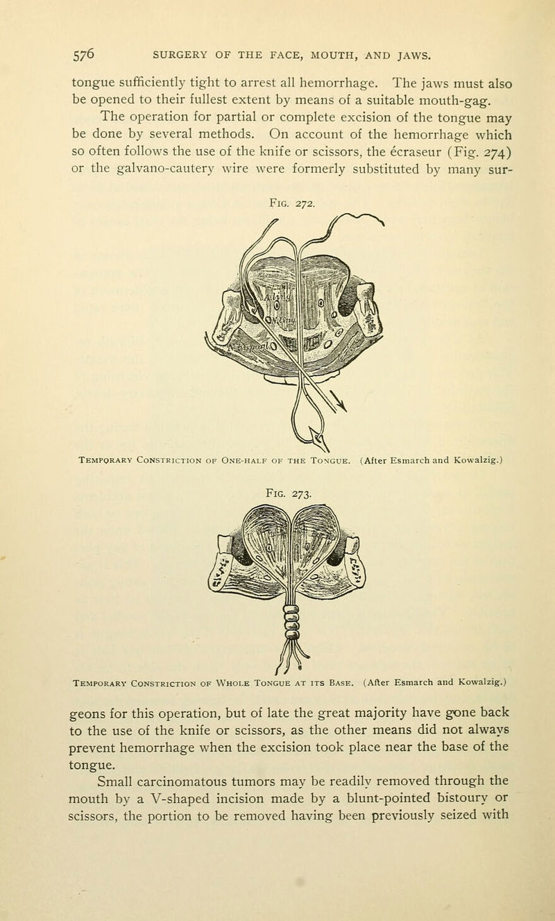 tongue sufficiently tight to arrest all hemorrhage. The jaws must also be opened to their fullest extent by means of a suitable mouth-gag. The operation for partial or complete excision of the tongue may be done by several methods. On account of the hemorrhage which so often follows the use of the knife or scissors, the ecraseur (Fig. 274) or the galvano-cautery wire were formerly substituted by many sur- FiG. 272. Temporary Constriction of One-half of the Tongue. (After Esmarch and Kowalzig.) Fig. 273. Temporary Constriction of Whole Tongue at its Base. (After Esmarch and Kowalzig.) geons for this operation, but of late the great majority have gone back to the use of the knife or scissors, as the other means did not always prevent hemorrhage when the excision took place near the base of the tongue. Small carcinomatous tumors may be readily removed through the mouth by a V-shaped incision made by a blunt-pointed bistoury or scissors, the portion to be removed having been previously seized with