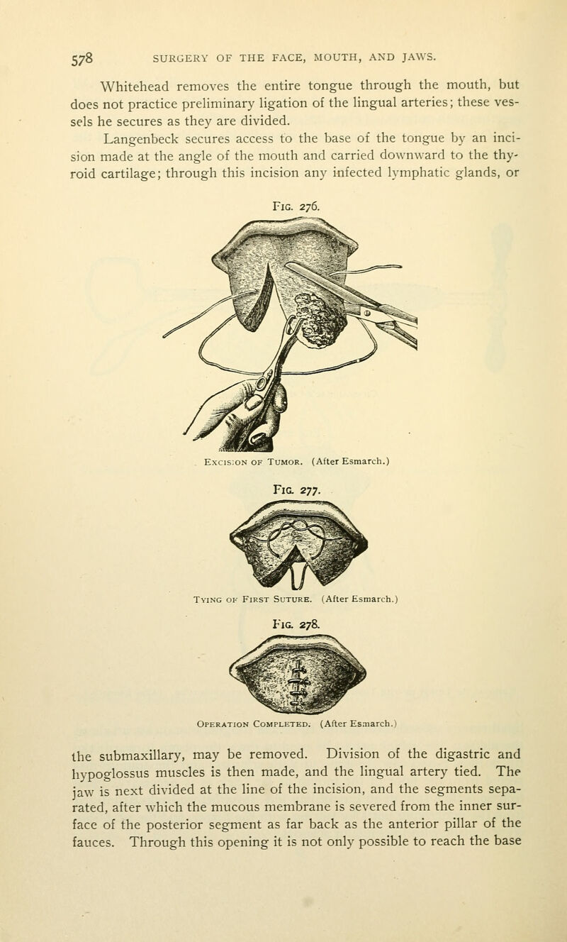 Whitehead removes the entire tongue through the mouth, but does not practice preliminary Hgation of the Hngual arteries; these ves- sels he secures as they are divided. Langenbeck secures access to the base of the tongue by an inci- sion made at the angle of the mouth and carried downward to the thy- roid cartilage; through this incision any infected lymphatic glands, or Fig. 276. Excis:oN OF Tumor. (After Esmarch.) Fig. 2^^. Tying ok First Suture. (After Esmarch.) Fig. 278. Operation Completed. (After Esmarch.) the submaxillary, may be removed. Division of the digastric and hypoglossus muscles is then made, and the lingual artery tied. The jaw is next divided at the line of the incision, and the segments sepa- rated, after which the mucous membrane is severed from the inner sur- face of the posterior segment as far back as the anterior pillar of the fauces. Through this opening it is not only possible to reach the base